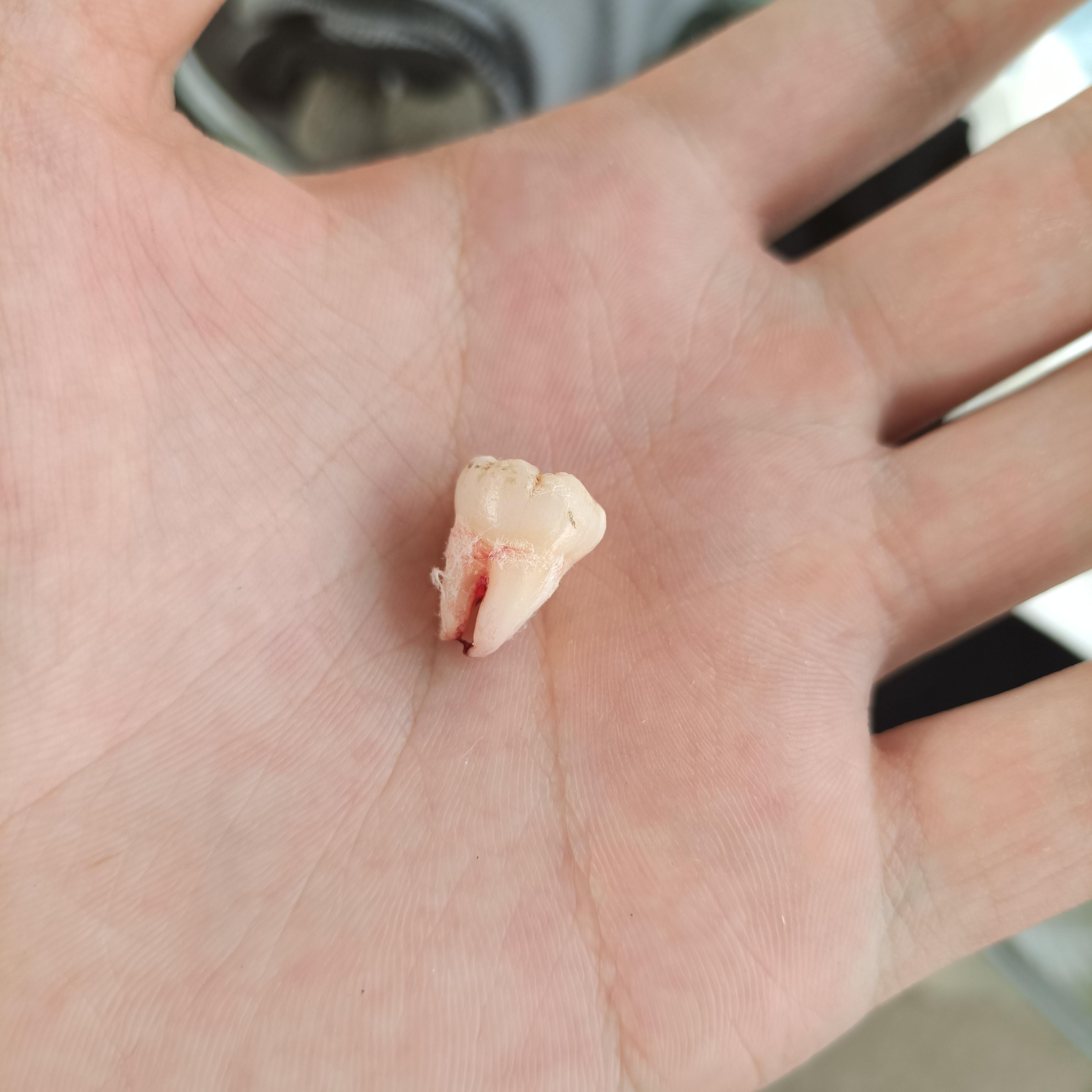 大家拔智齿以后缝针了吗? - 知乎