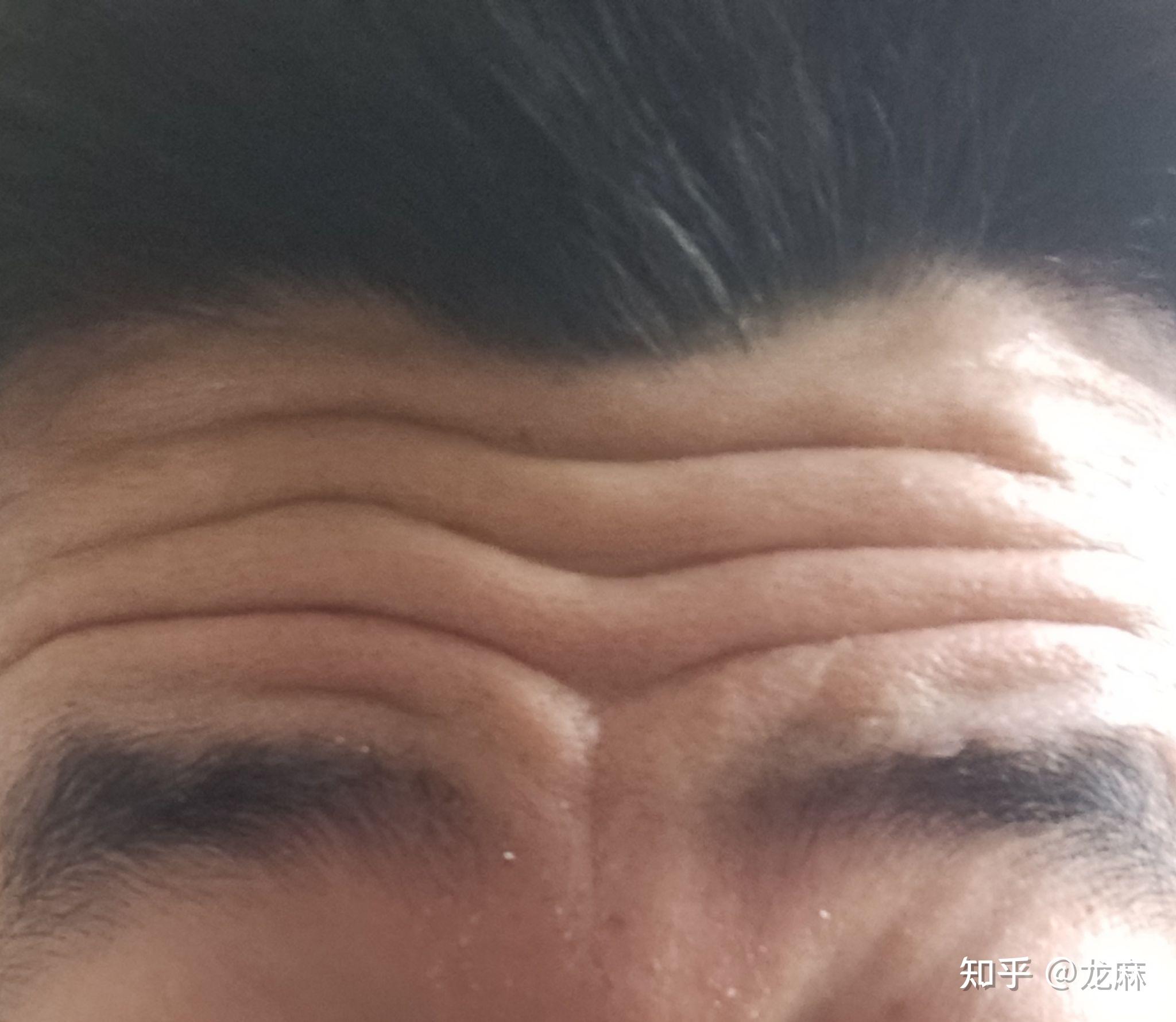 请问这抬头纹还有救吗(16岁)? - 知乎