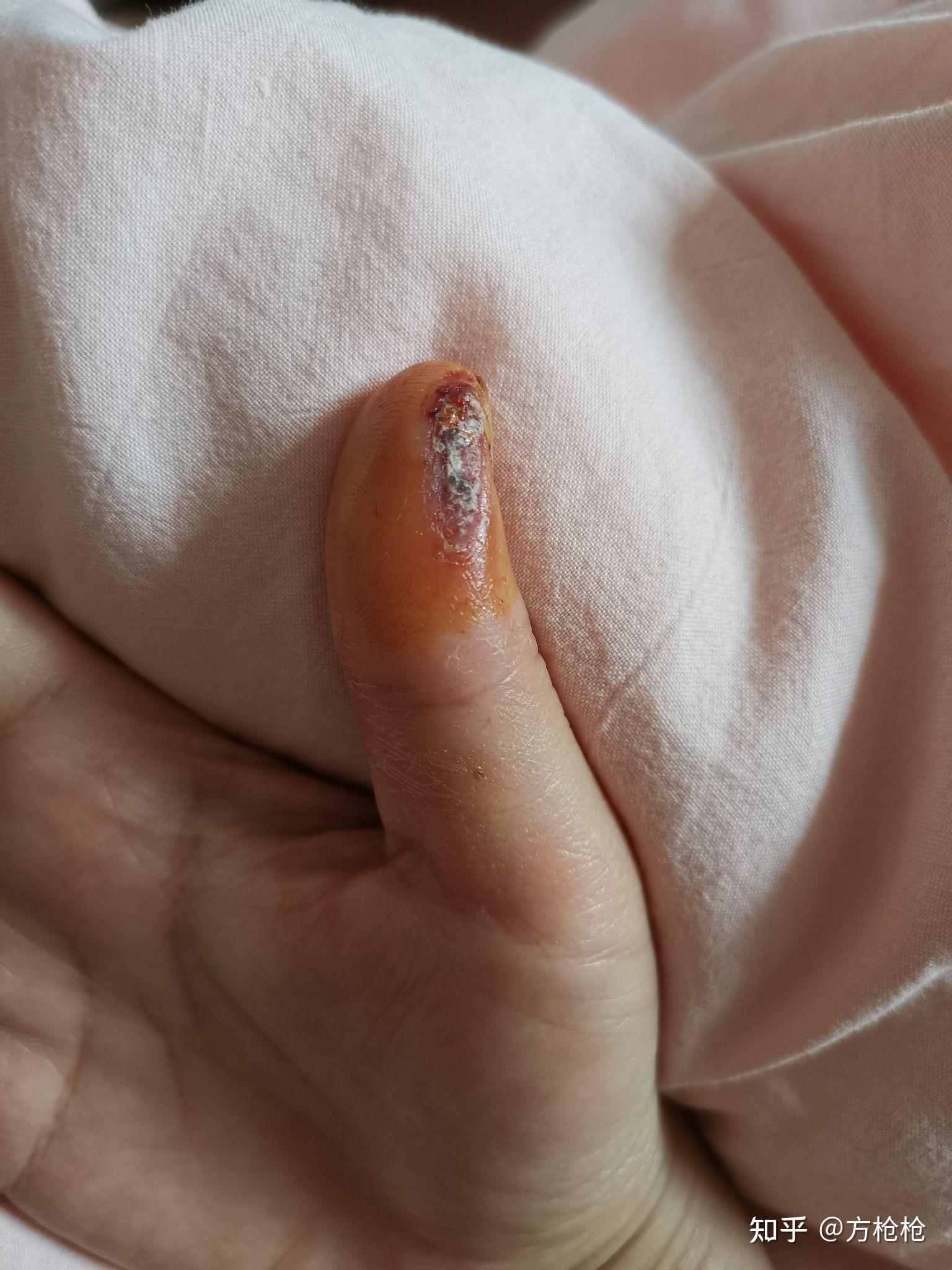 手指被切下一块肉,多长时间能恢复? - 知乎