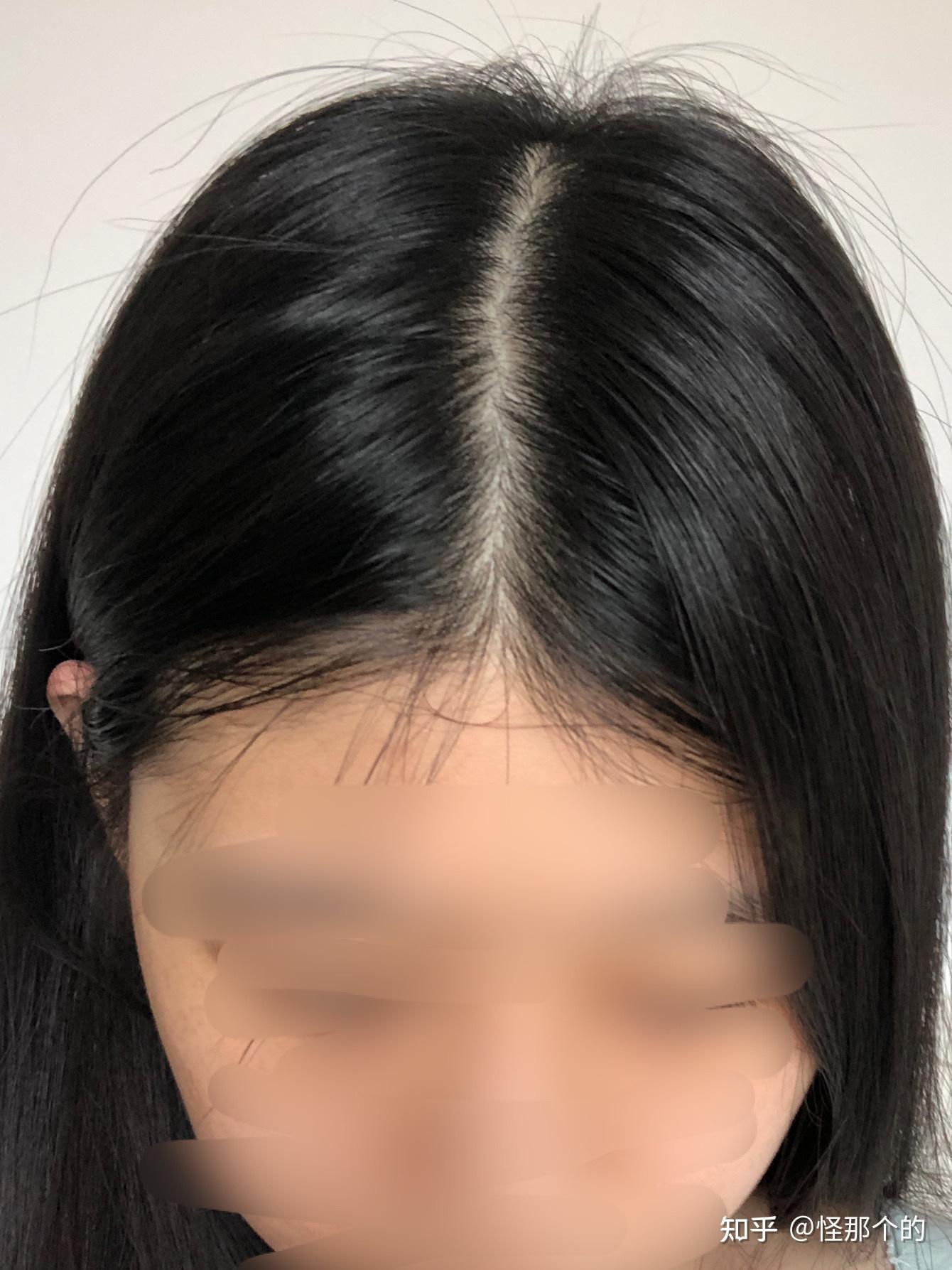 突然发现发缝好宽啊我是不是要秃了?