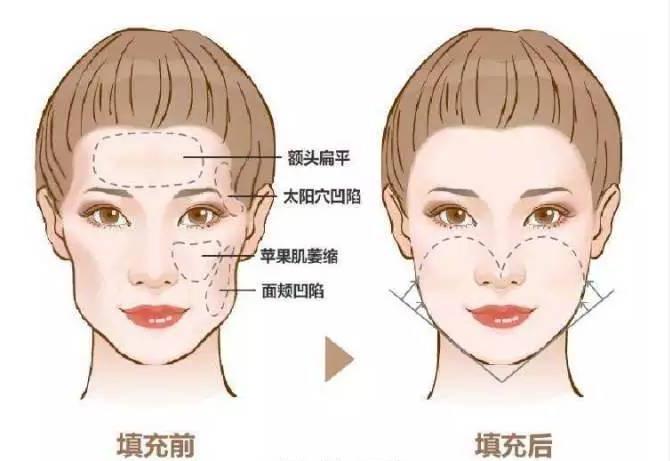 如何判断面部是几级凹陷?一招教你自测! - 知乎