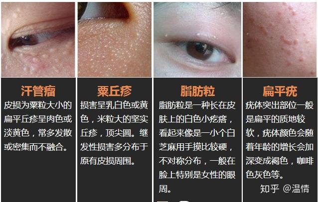 怎么消除眼睛上的脂肪粒