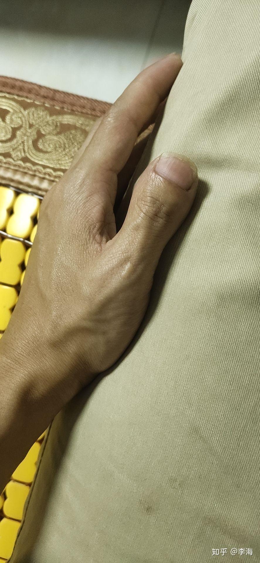 大拇指好丑好短好宽怎么办! - 知乎