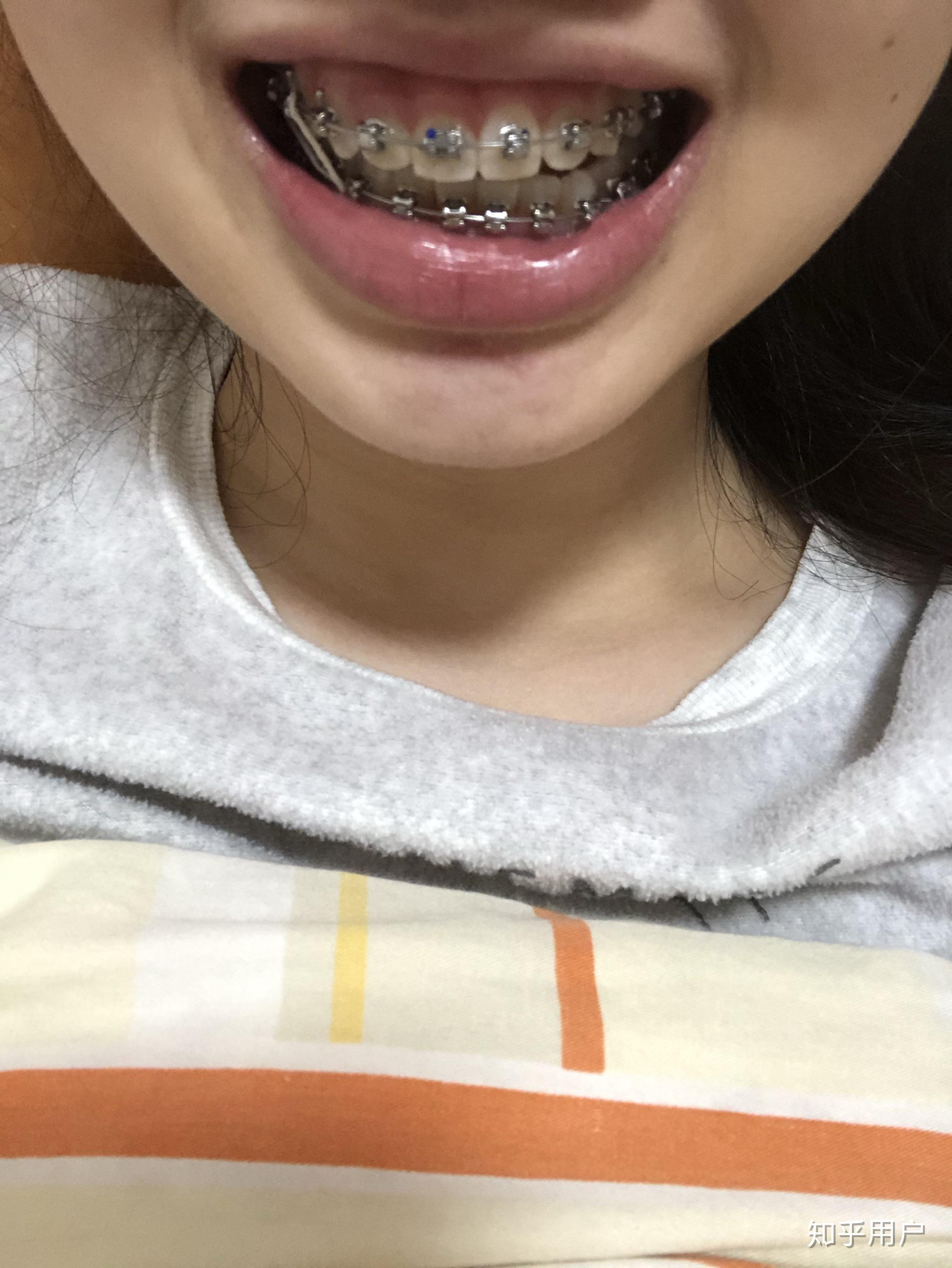 牙齿高低不平挺明显的跟医生说了她说没问题这样没问题嘛还是应该继续