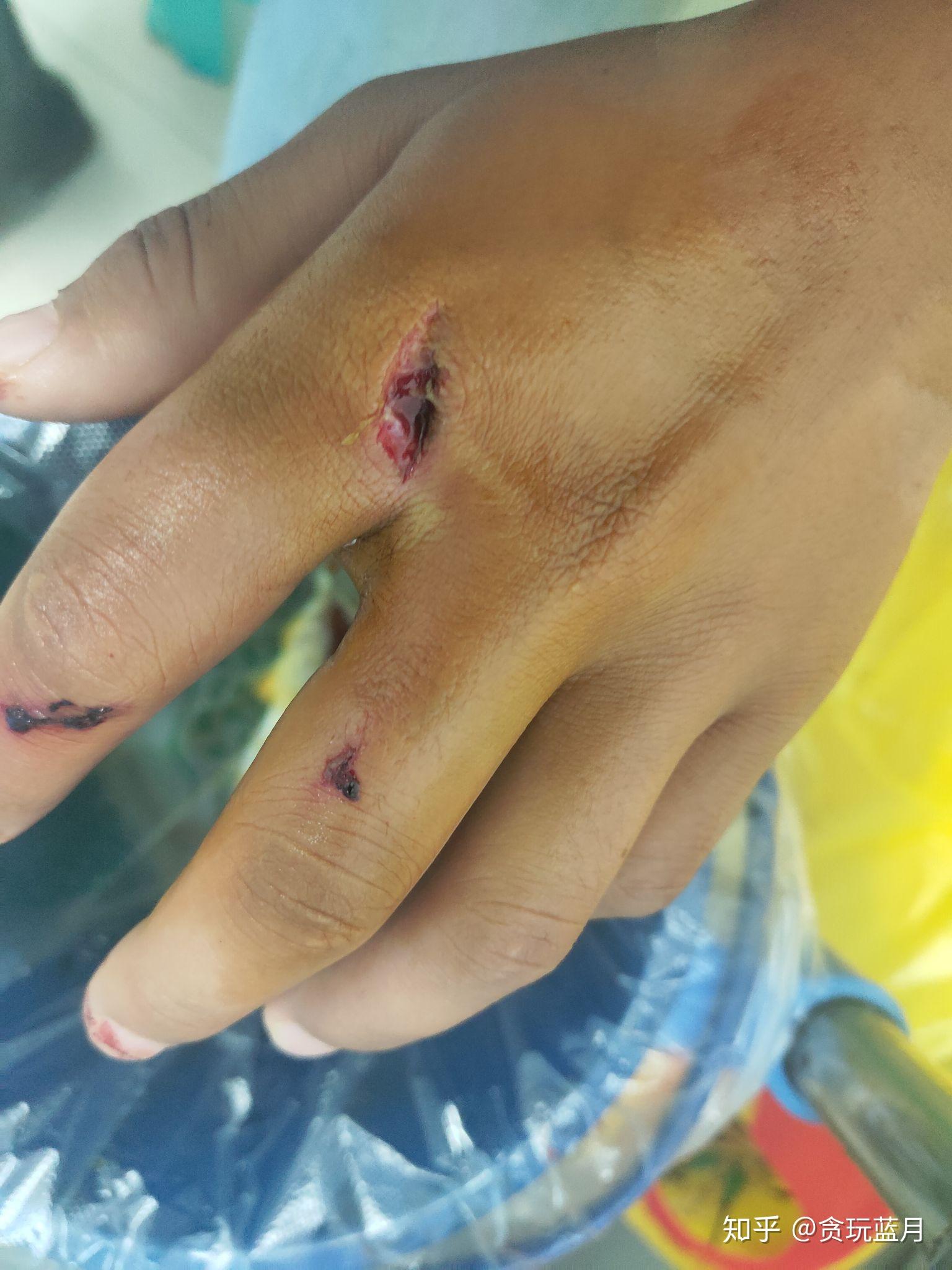 工地受伤骨折怎么赔偿