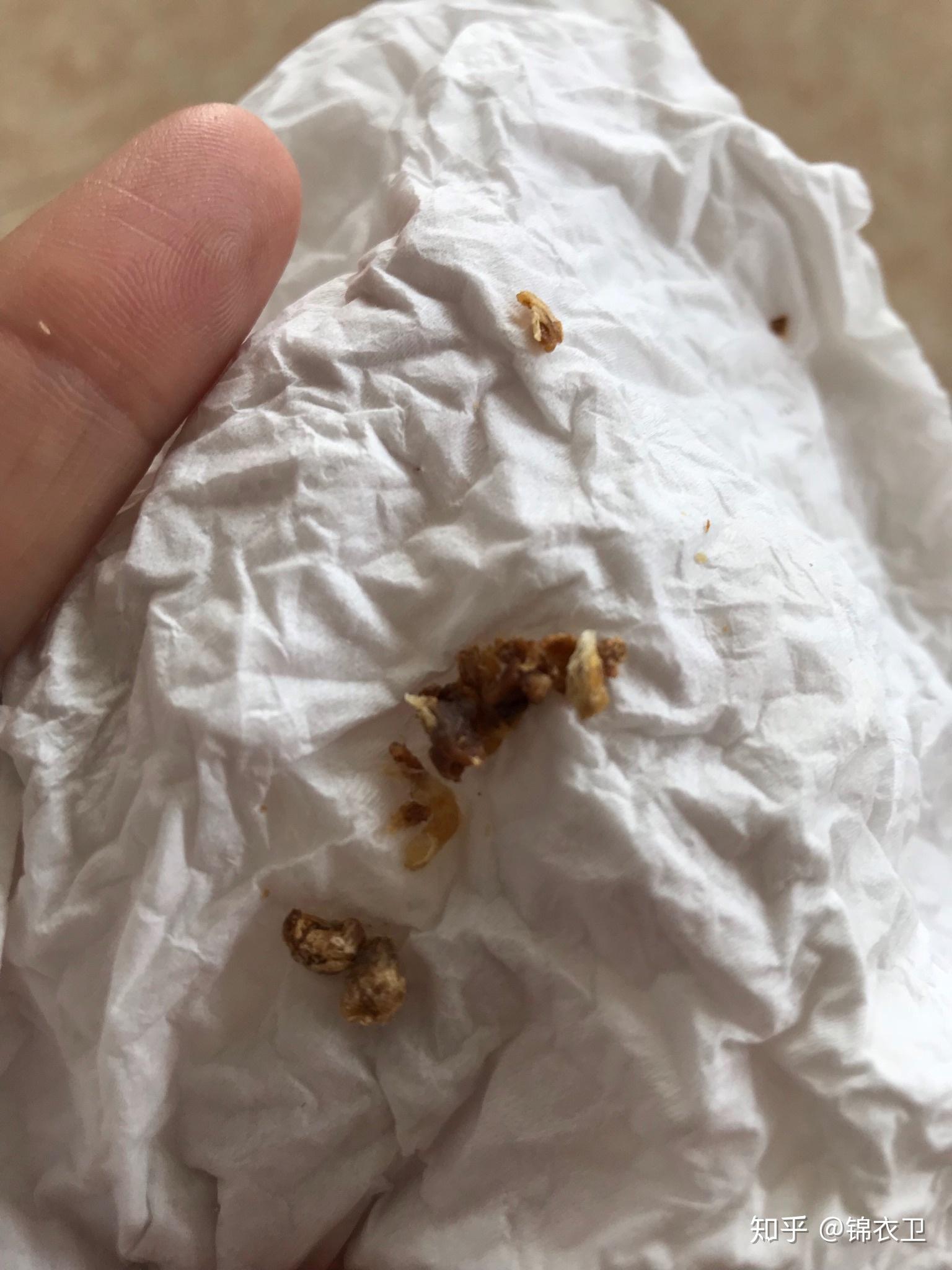 去医院挖耳屎是一种什么样的体验