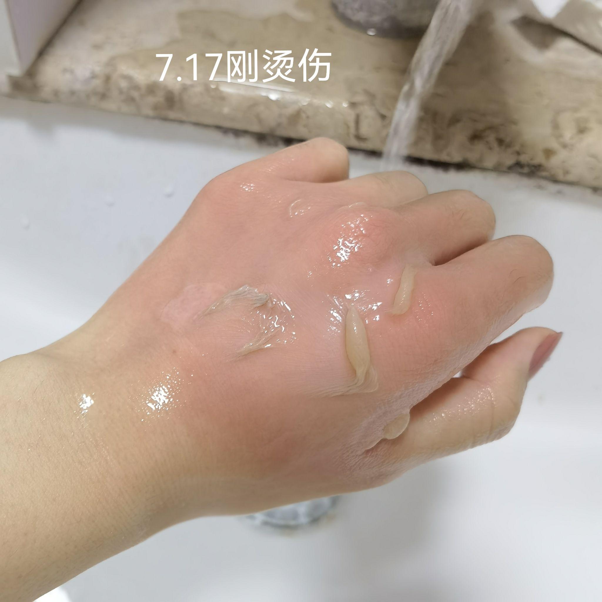 手背被开水二度烫伤恢复过程