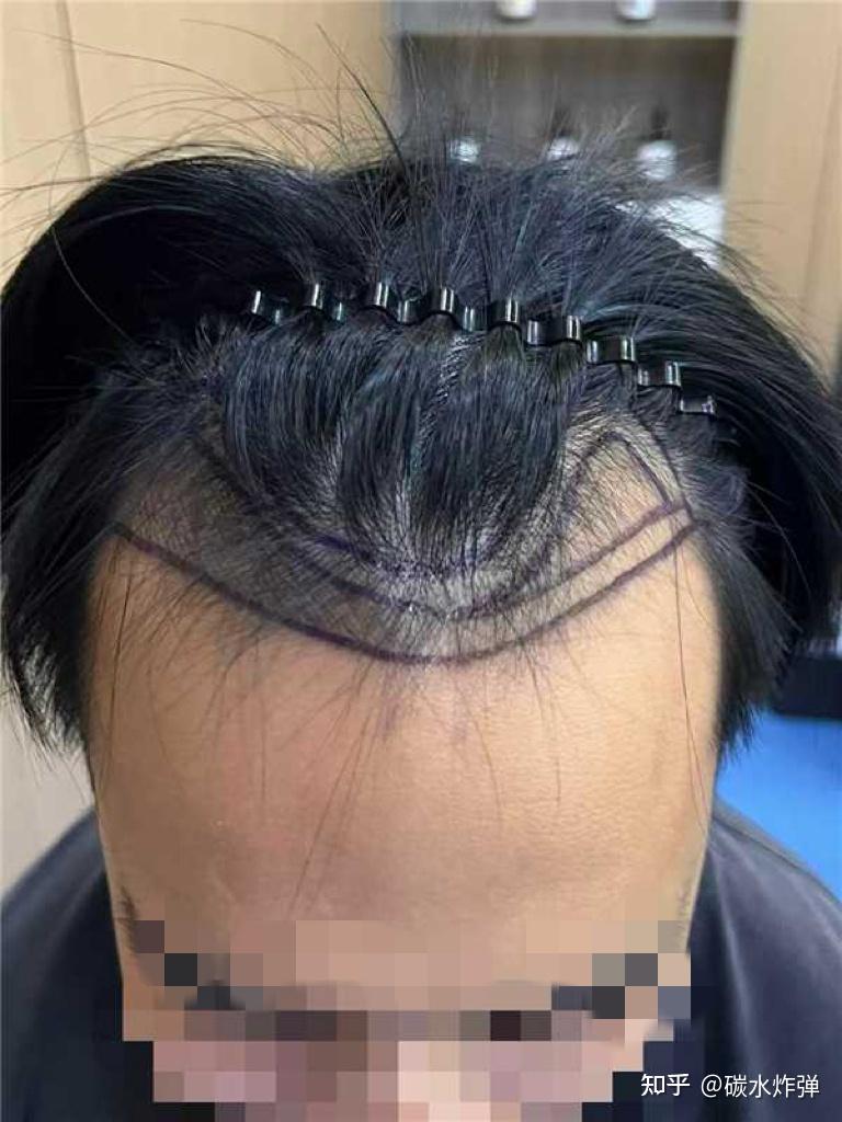 2045 单位剃发植发,5 天!男生发际线终于不 “后移” 了 - 知乎
