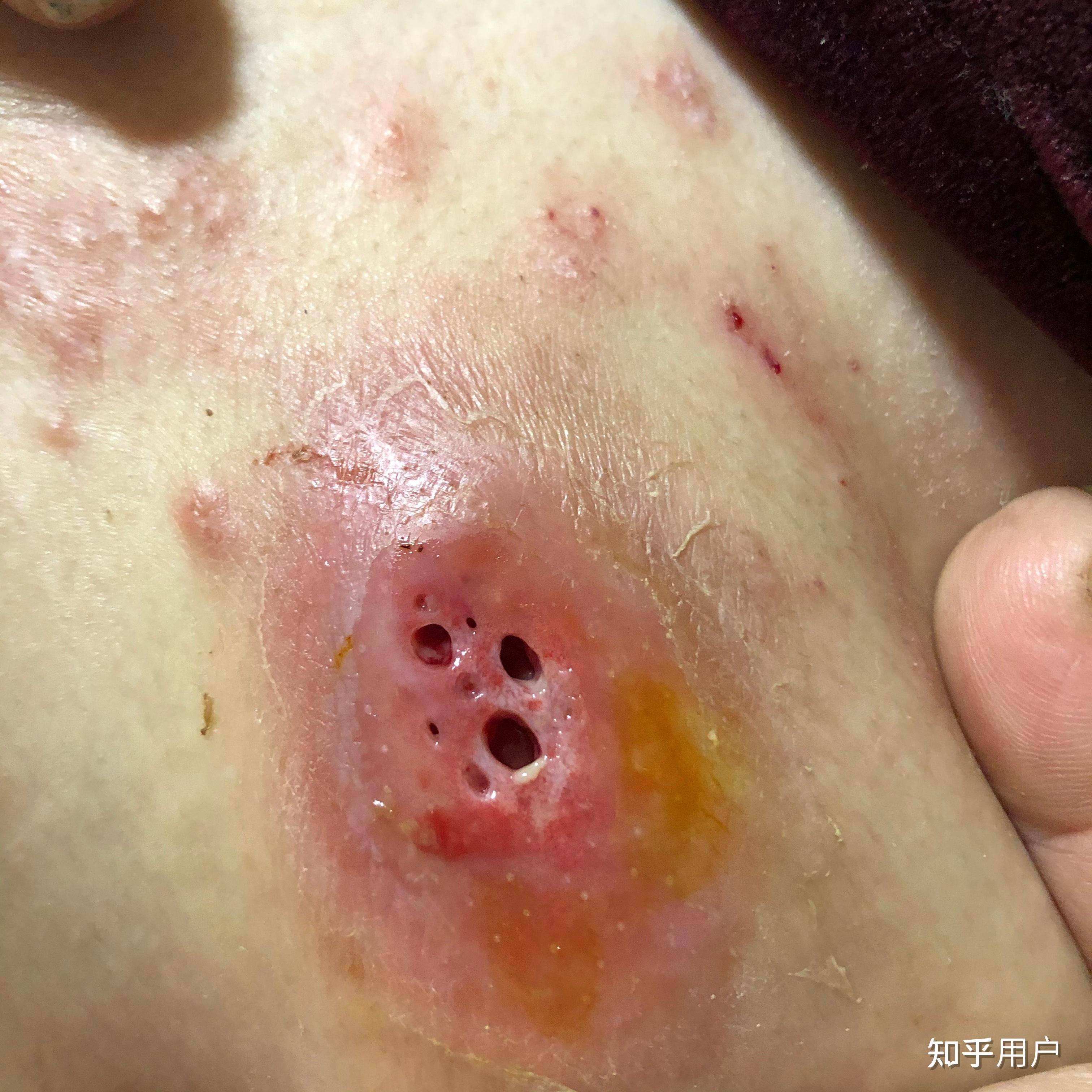 人体的火疖子 (化脓性毛囊及毛囊深部周围组织的感染) 能有多大?