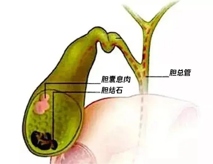 胆囊息肉成因是什么,不吃晚饭会引发或者加重胆囊息肉吗?