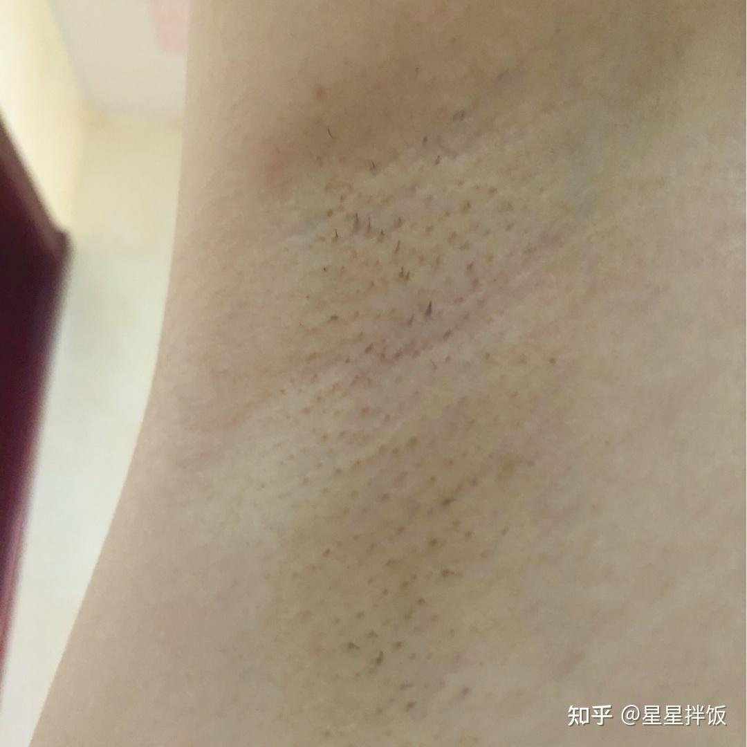 为什么剔完腋毛,腋下还是黑的,那些明星为什么能伸起胳膊腋下的皮肤那么光滑而且颜色与周围一致? - 知乎