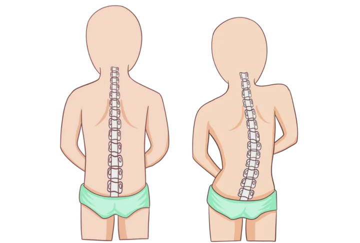 为什么胸椎侧凸经常发生在右侧?