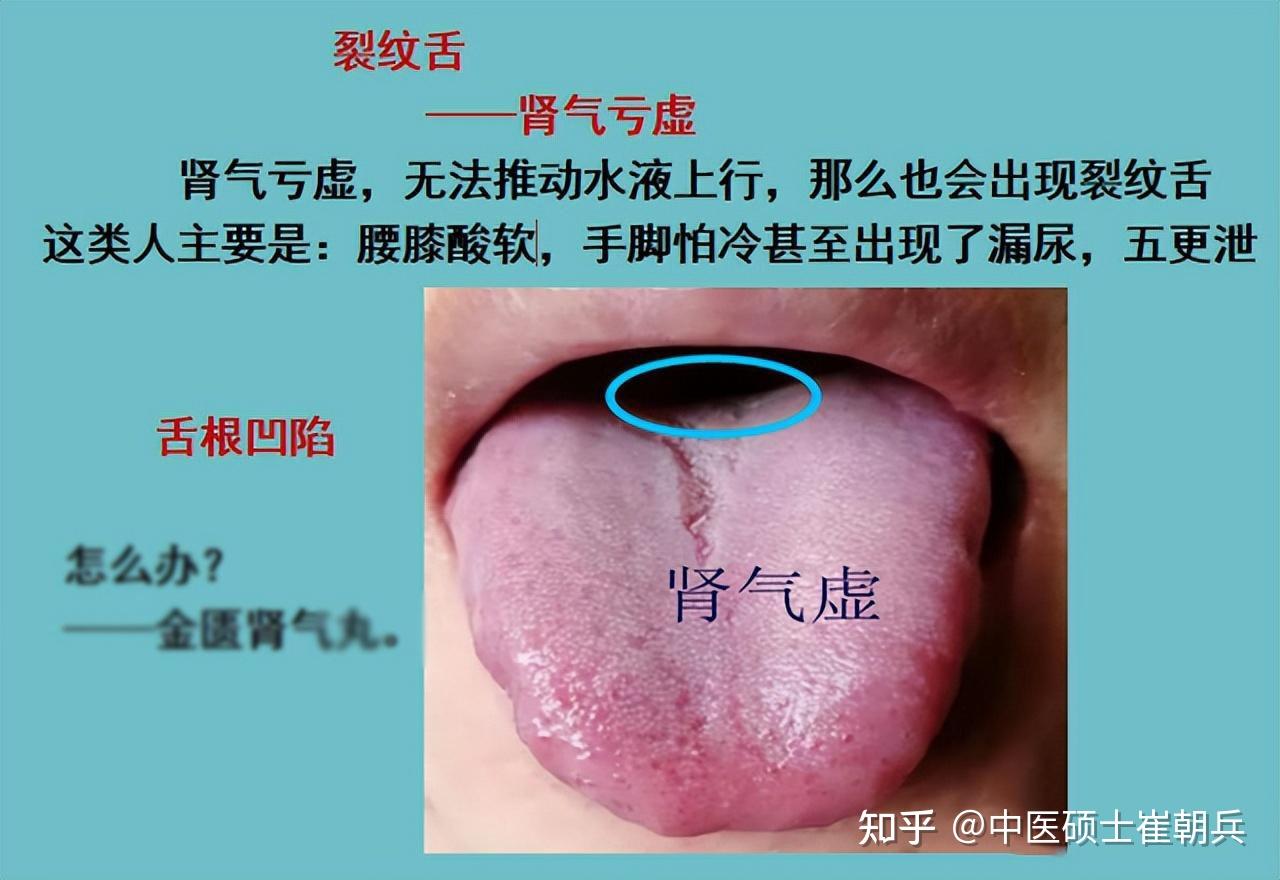舌头有轻微裂纹湿润竖纹