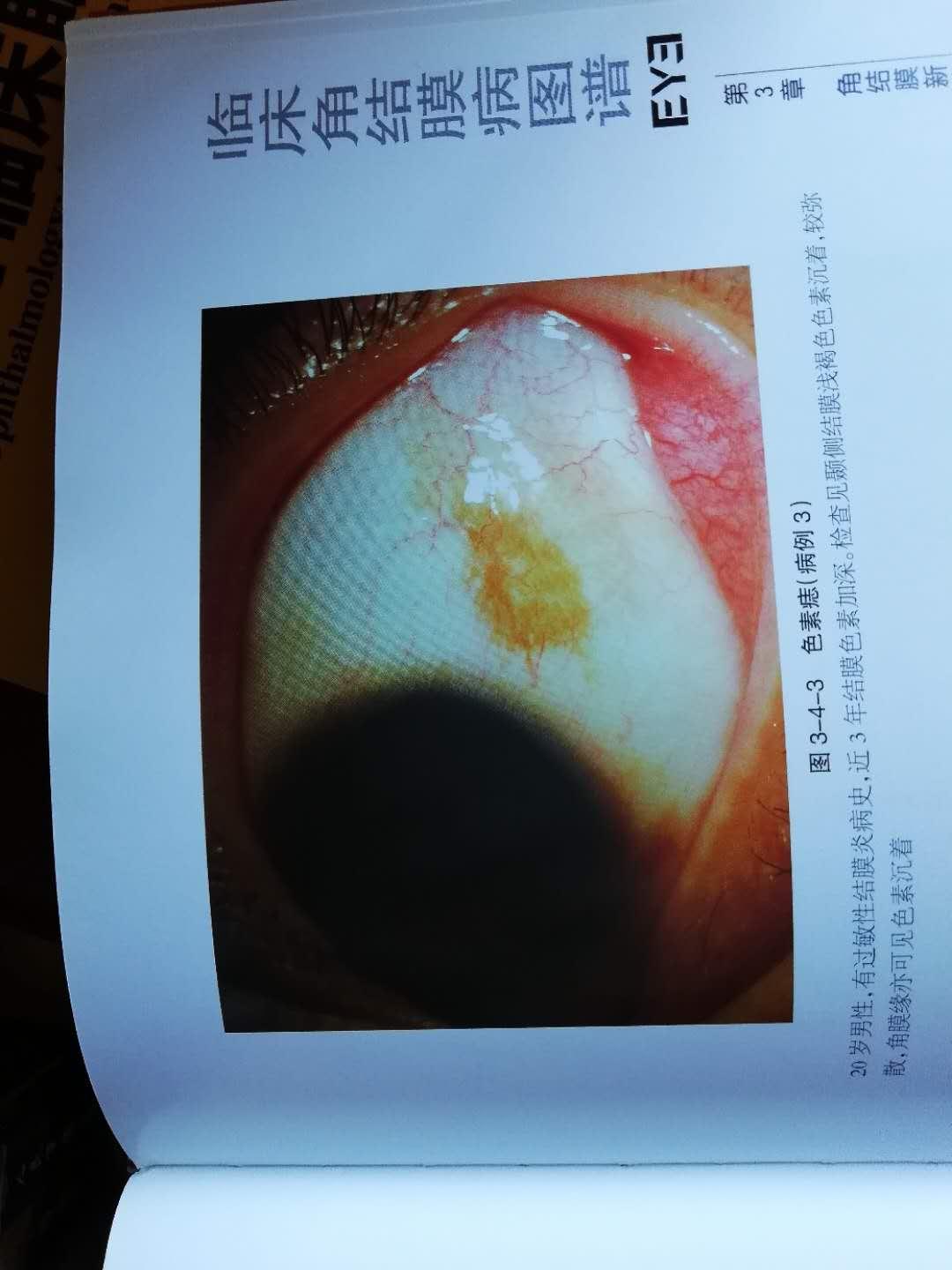巩膜虫斑图片图片
