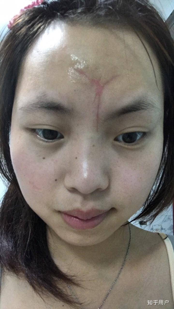 女生脸上有疤是怎样的体验