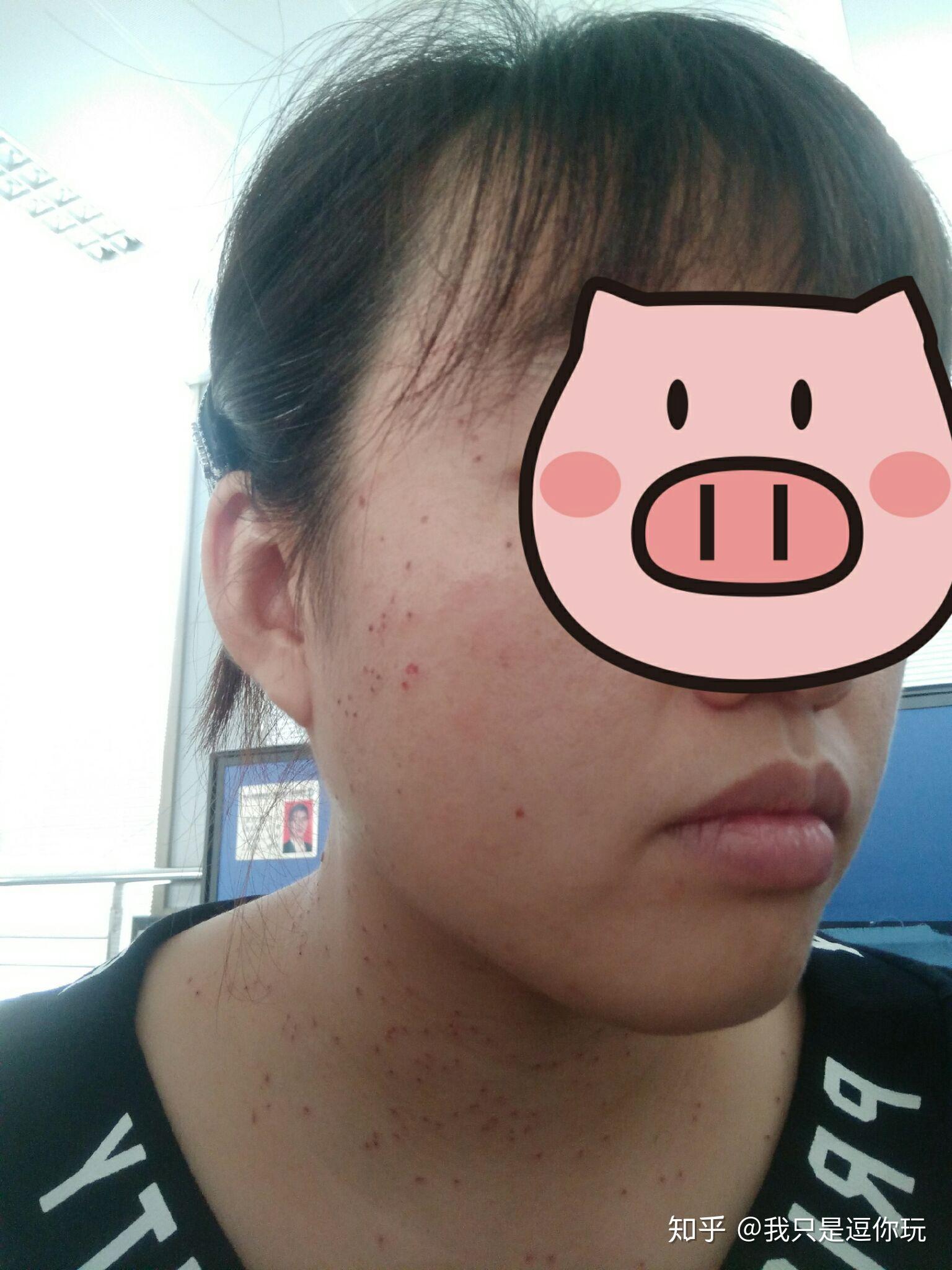 丝状疣,脖子上,女性,医生说要激光扫,有别的办法吗?