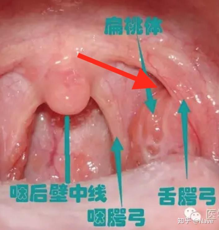 看知乎上那么多人都能自己清理扁桃体结石,就我不能,为什么? - 知乎