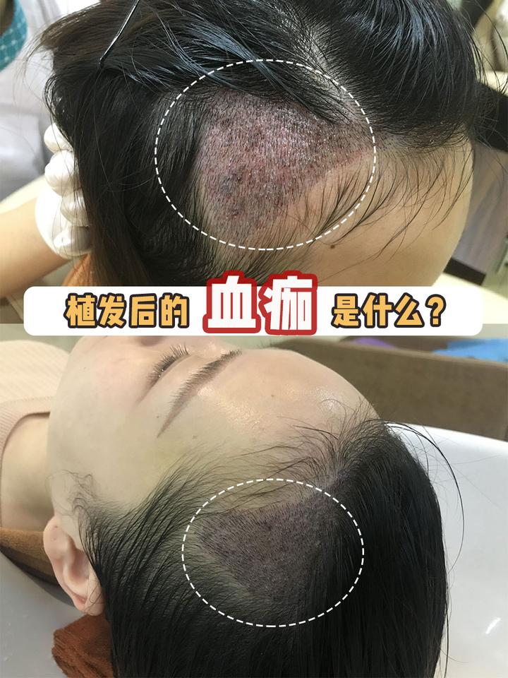 植发后的血痂是什么? - 知乎
