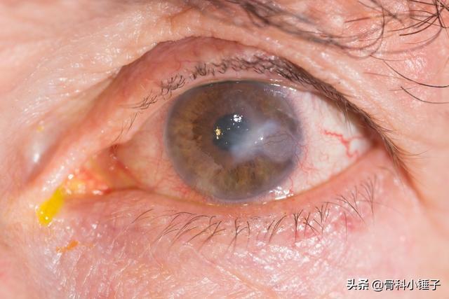 单纯疱疹病毒性角膜炎概述