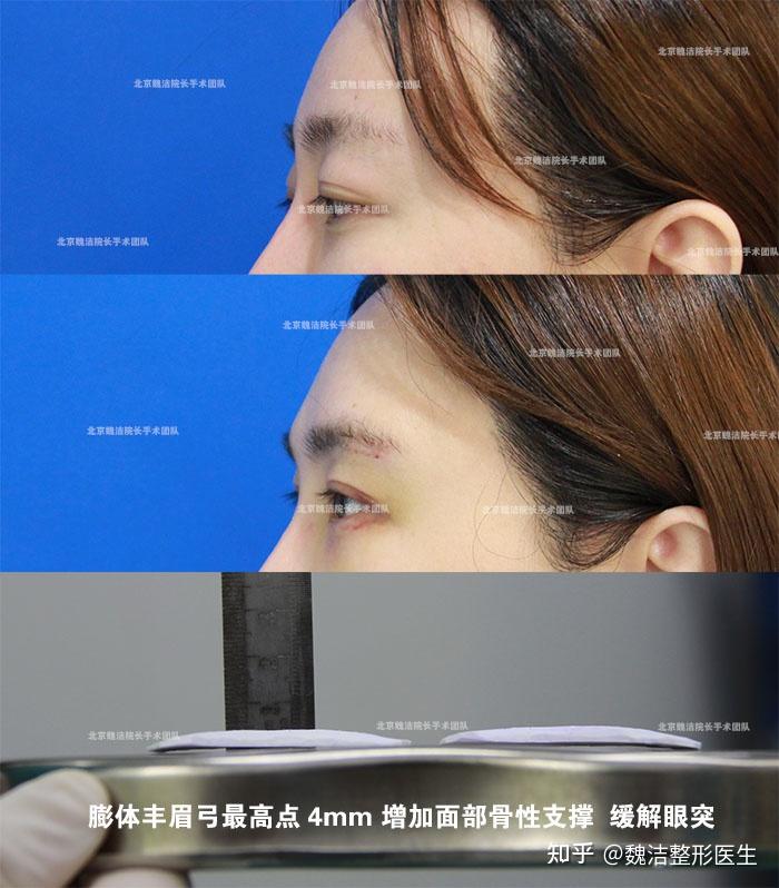 膨体丰眉弓拆线时肿胀是什么样的?垫了眉弓需要休息多久形态才能自然? - 知乎