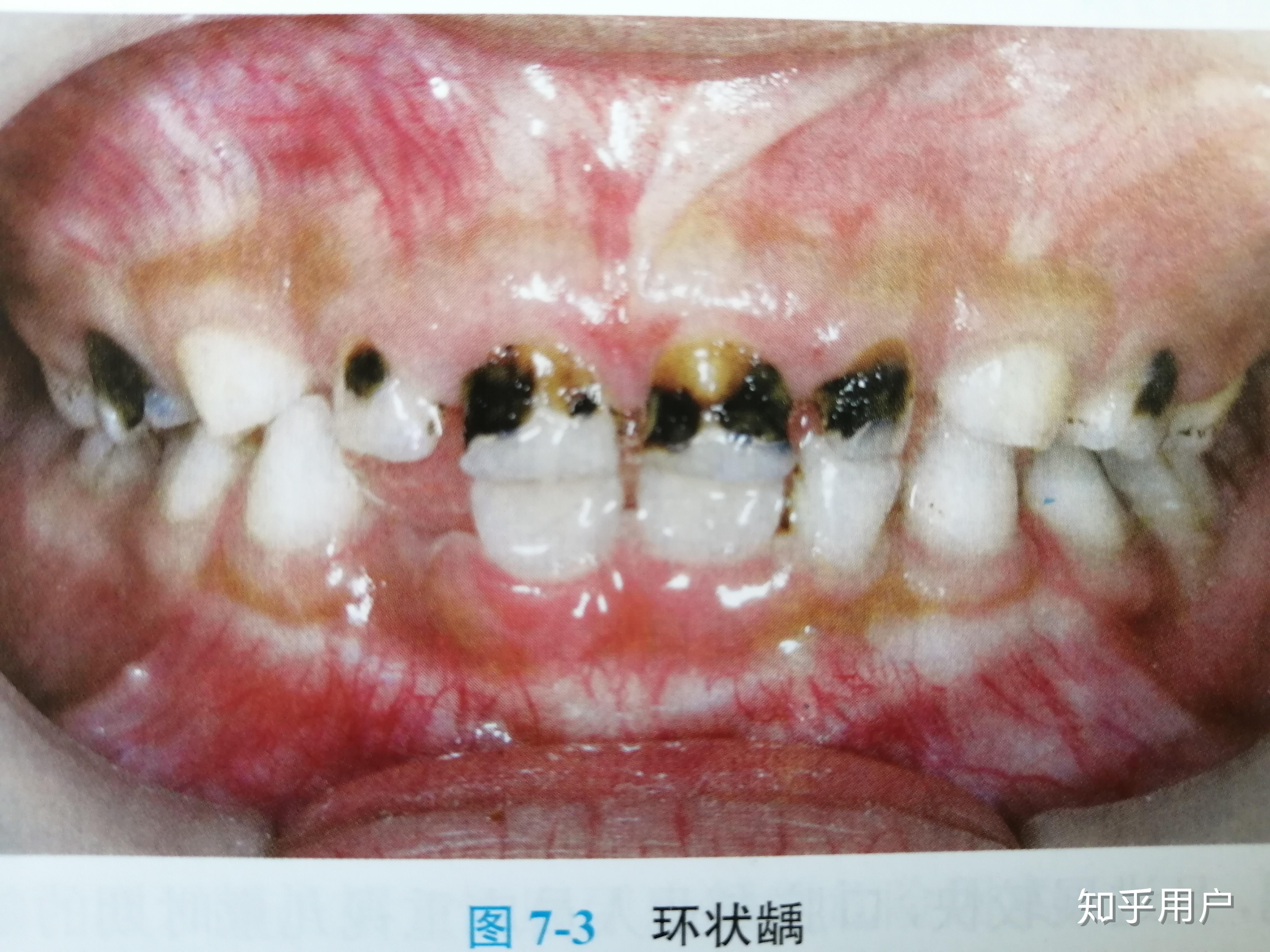 什么是「奶瓶龋」?有什么症状?如何预防和治疗? - 知乎