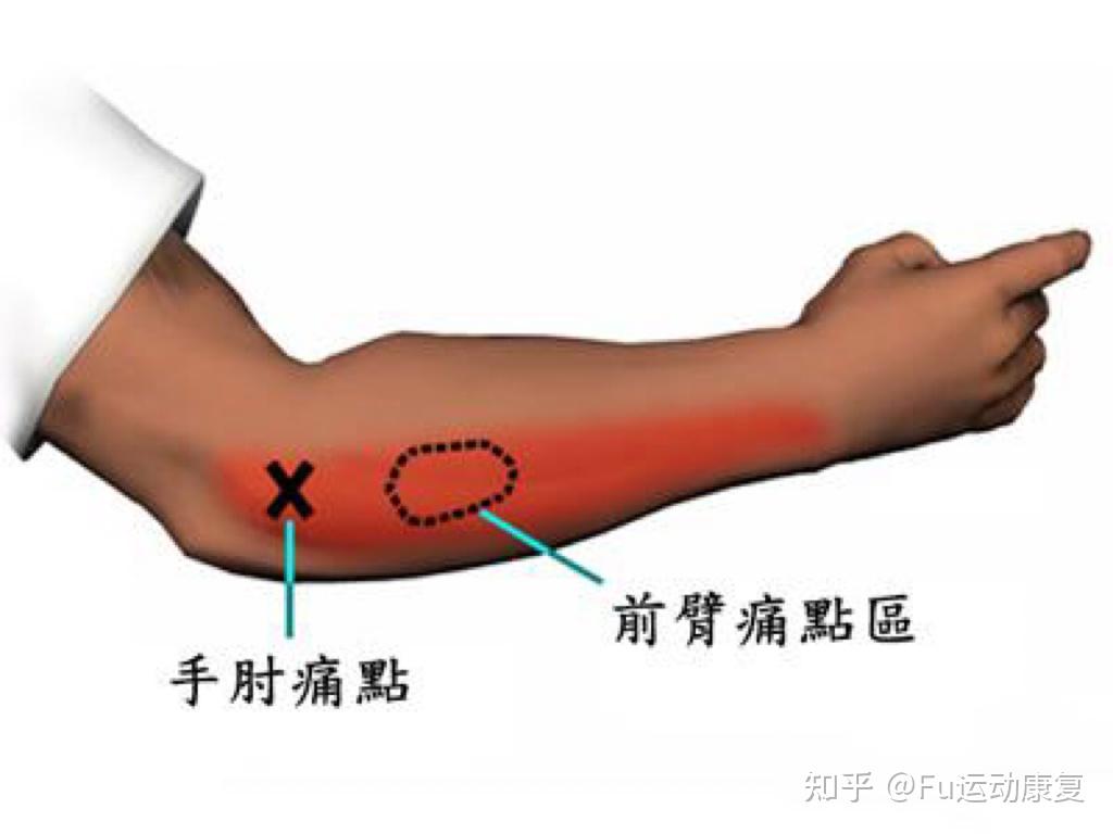 伤病丨三个足底筋膜炎及跟腱炎恢复动作_损伤