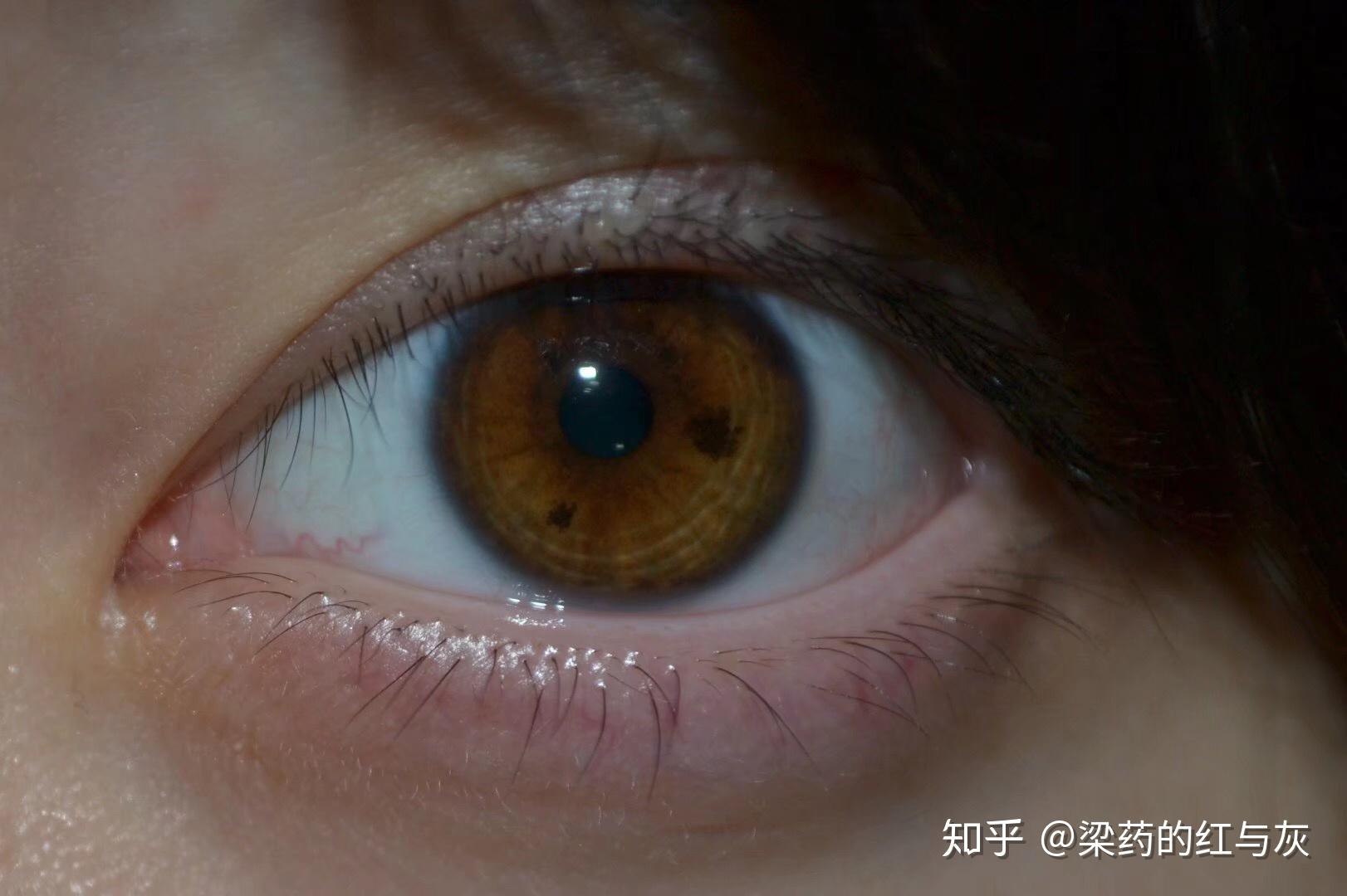 拥有不寻常的虹膜是种怎样的体验