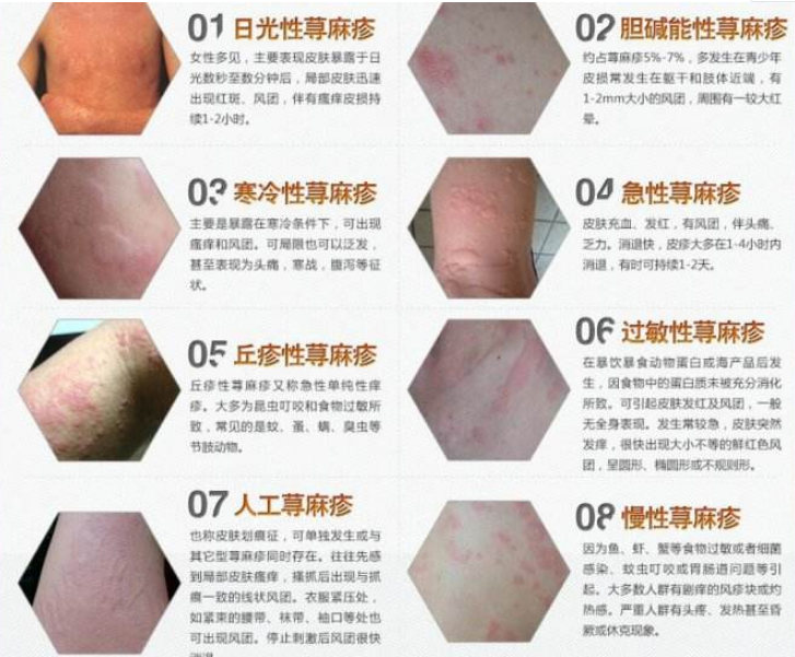 How to treat cold urticaria(寒性荨麻疹如何治疗)