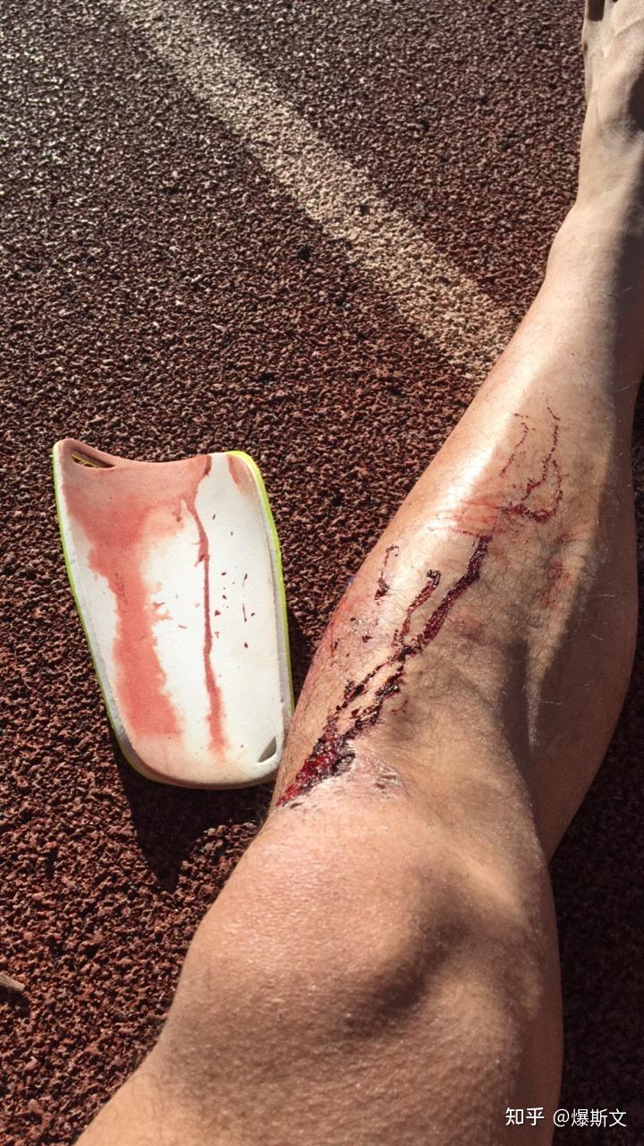 踢球时被铲是什么样的体验? - 知乎