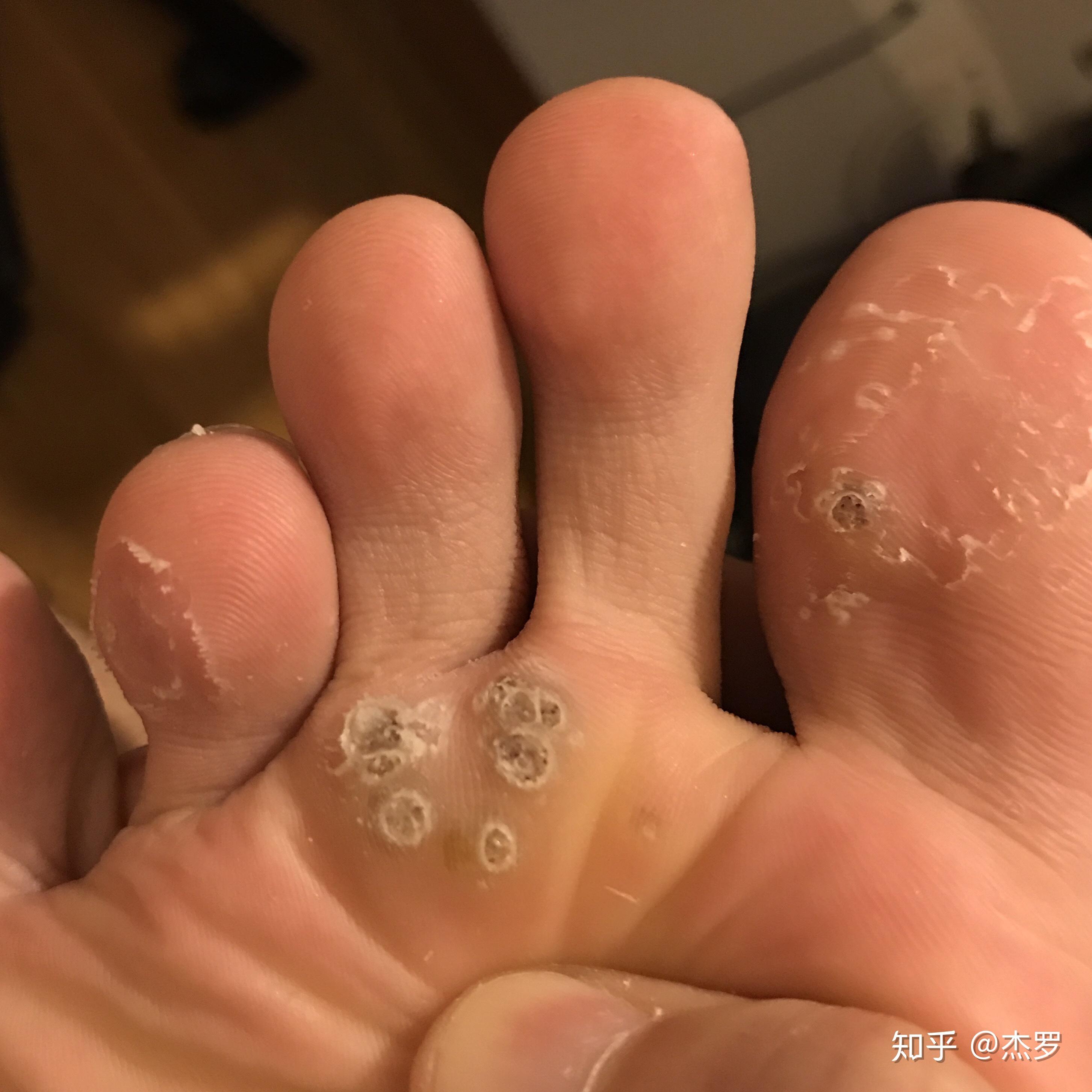 跖疣的自愈性大吗