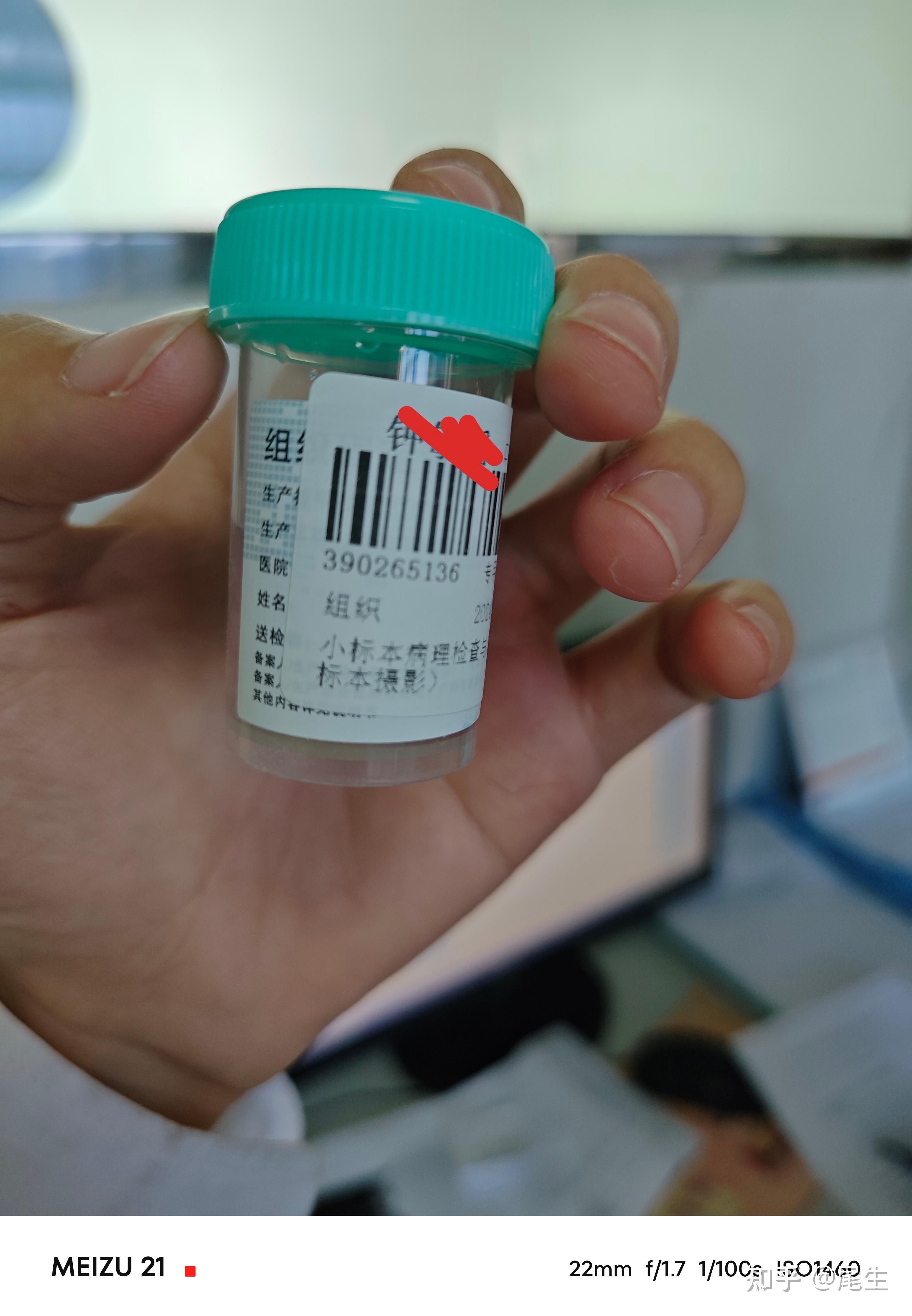 下嘴唇长了个粘液腺囊肿,两年多了,不痛不痒,也没长大,但扒在嘴里头