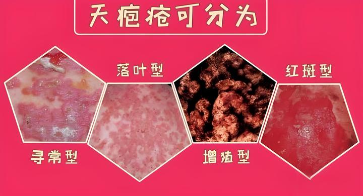 天胞疮吃什么药?中医一方让患者化解“皮肤危机” - 知乎