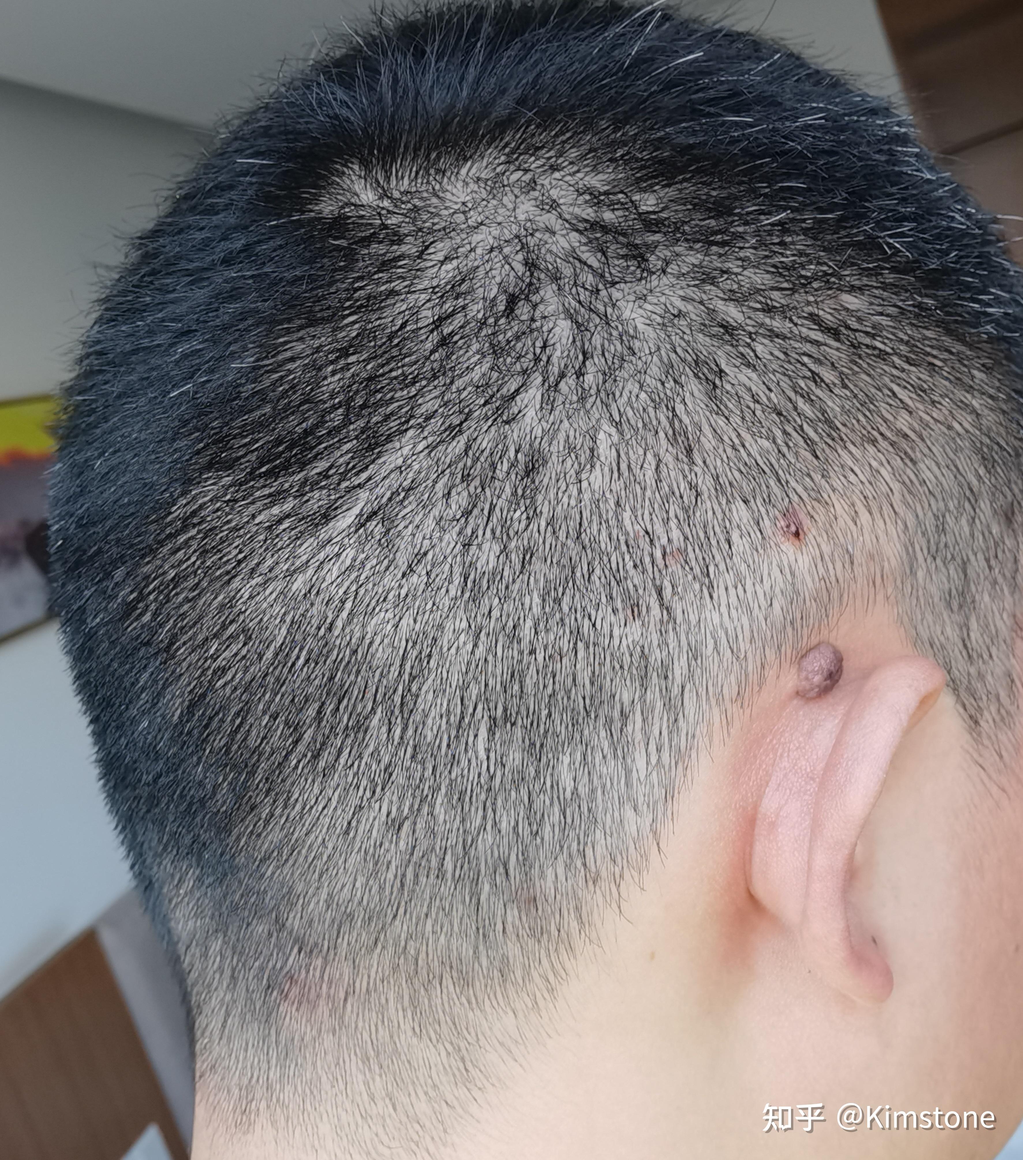 毛囊炎好的治疗方法