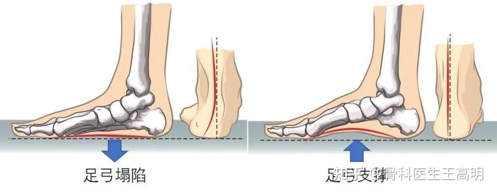 足弓塌陷:危害不容小觑,你必须知道的那些事 - 知乎