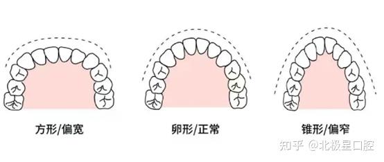 正常牙弓形状图片图片