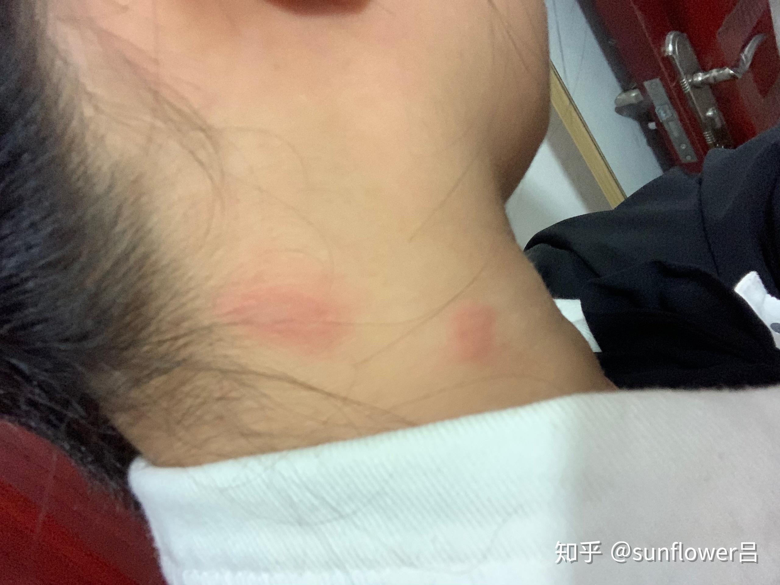被隐翅虫咬了会怎么样? - 知乎