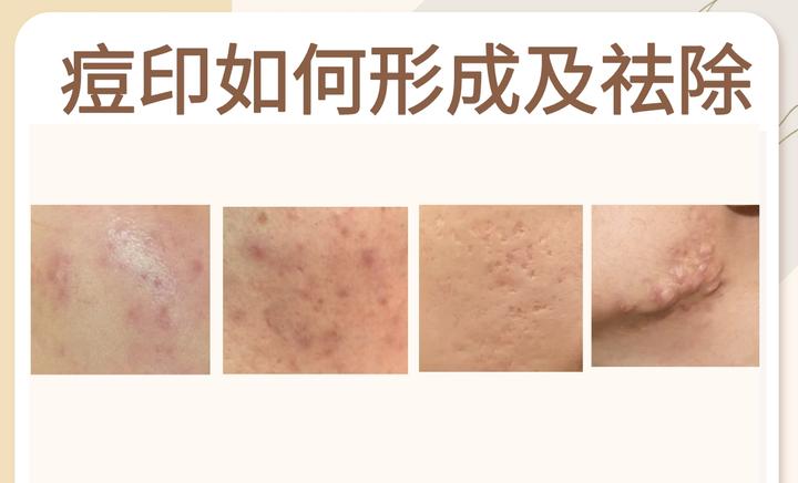 痘印和痘坑是如何形成的?怎么祛除? - 知乎