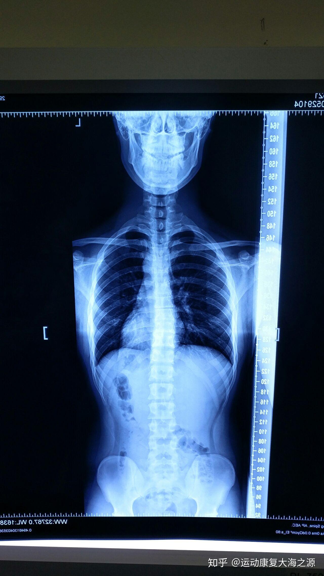 正常小孩脊椎骨图片图片