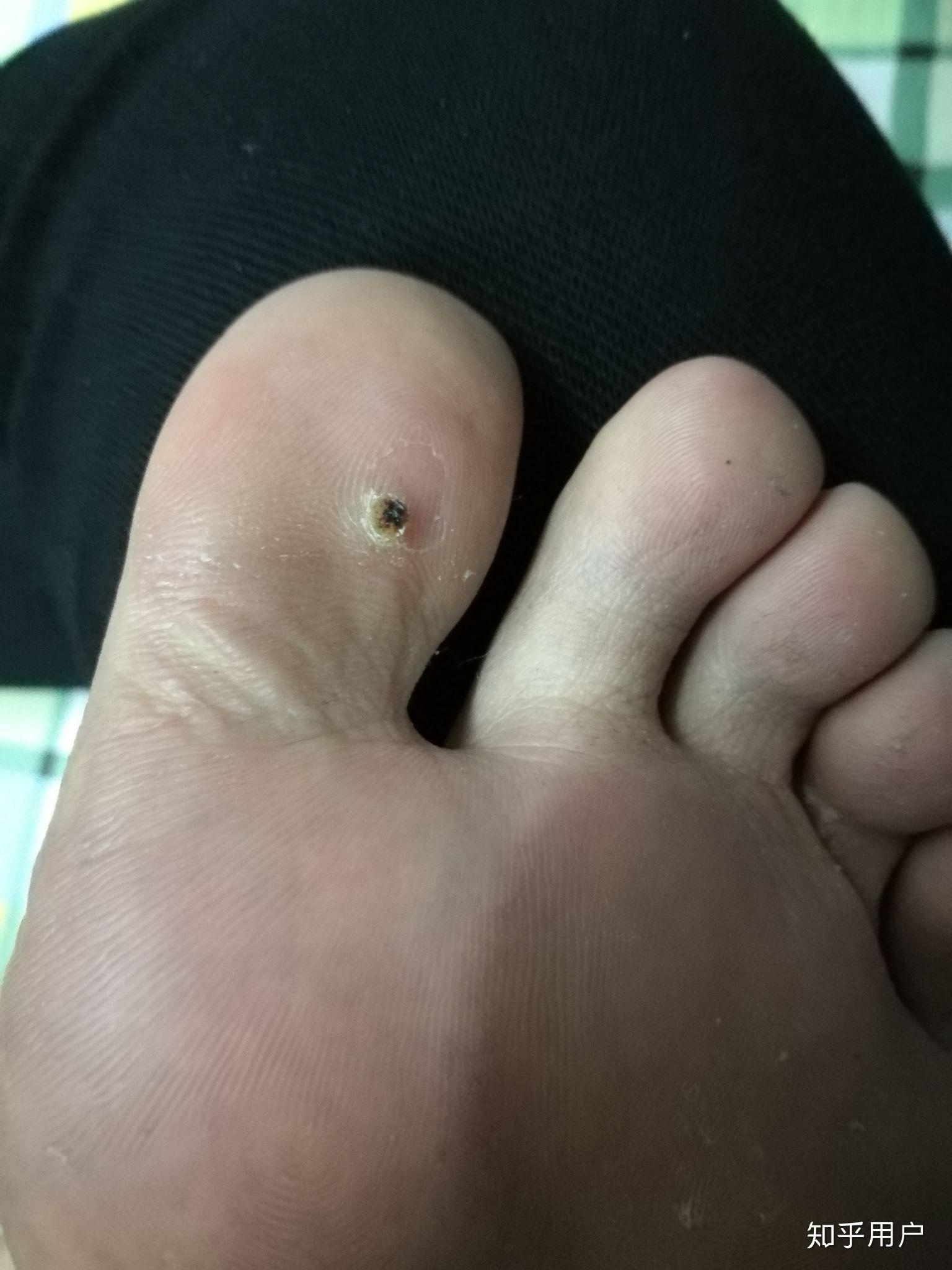 有人知道怎么治疗足底疣? - 知乎