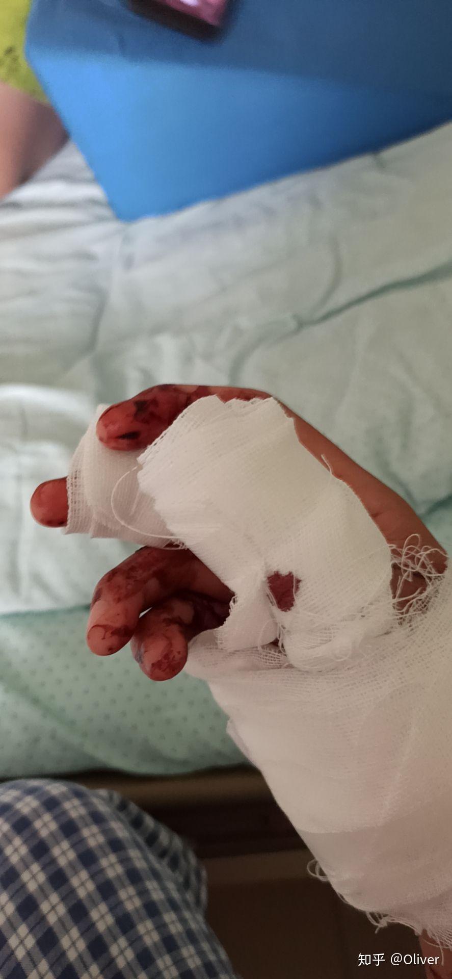 请问一拳打墙上,软组织挫伤能不能自愈,能的话大概要多长时间? - 知乎