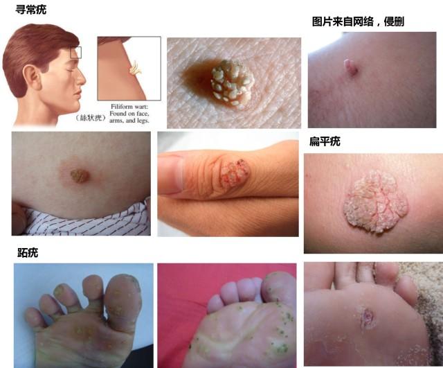 一张图教你辨别疣!常见的皮肤疣有哪些?