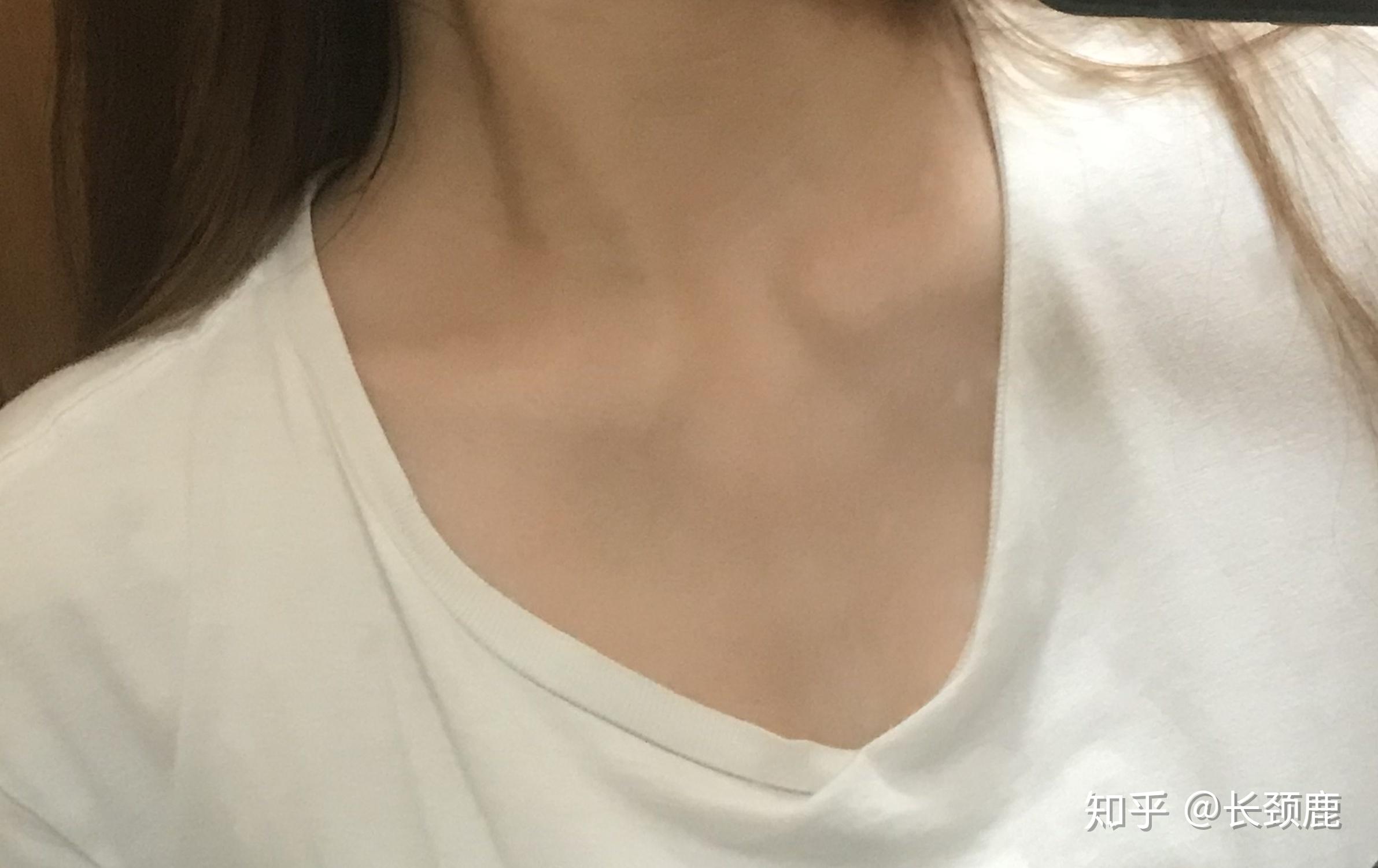 女生胸肌中间凹陷是什么原因啊