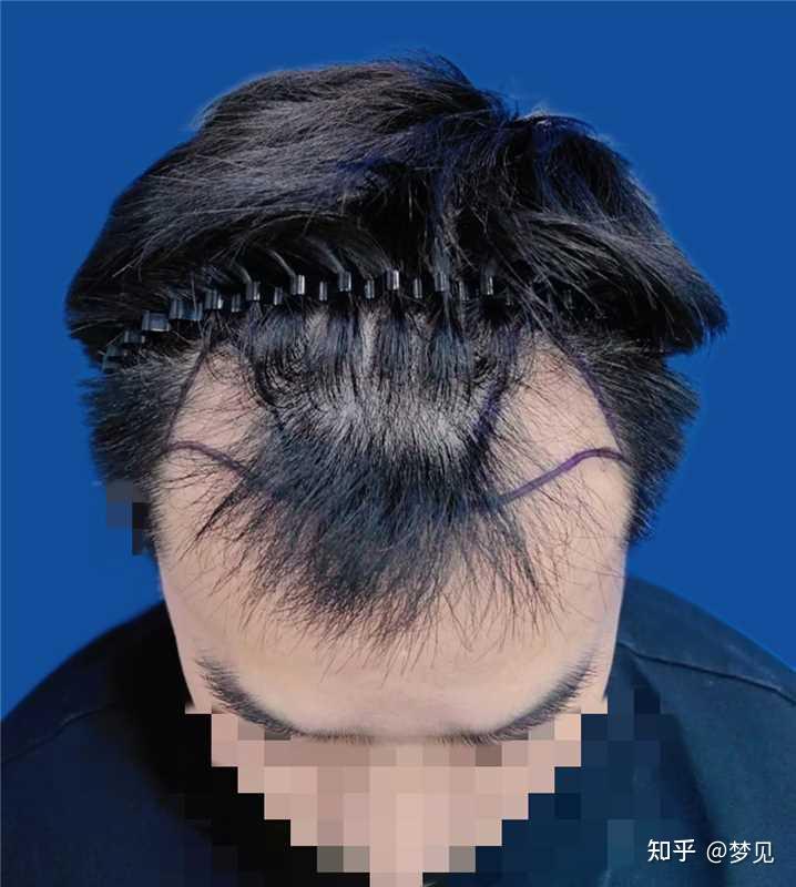 额角 M 秃不剃发植发2080单位5天,头顶记录一下 - 知乎