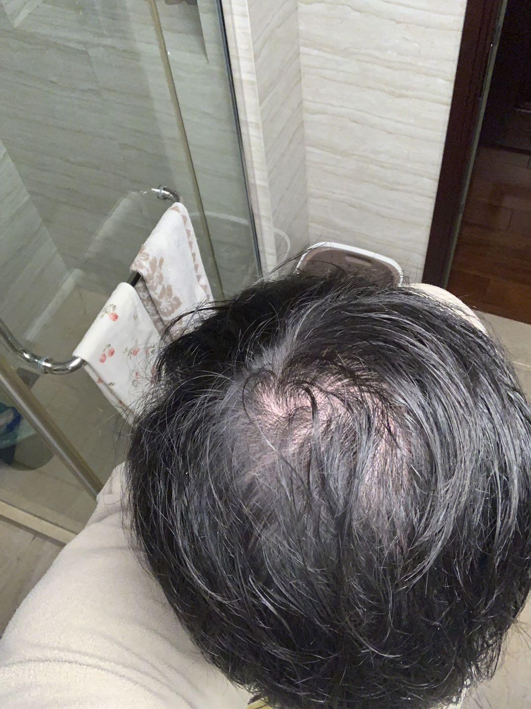 头顶旋处快秃了怎么办?(有图)? - 知乎