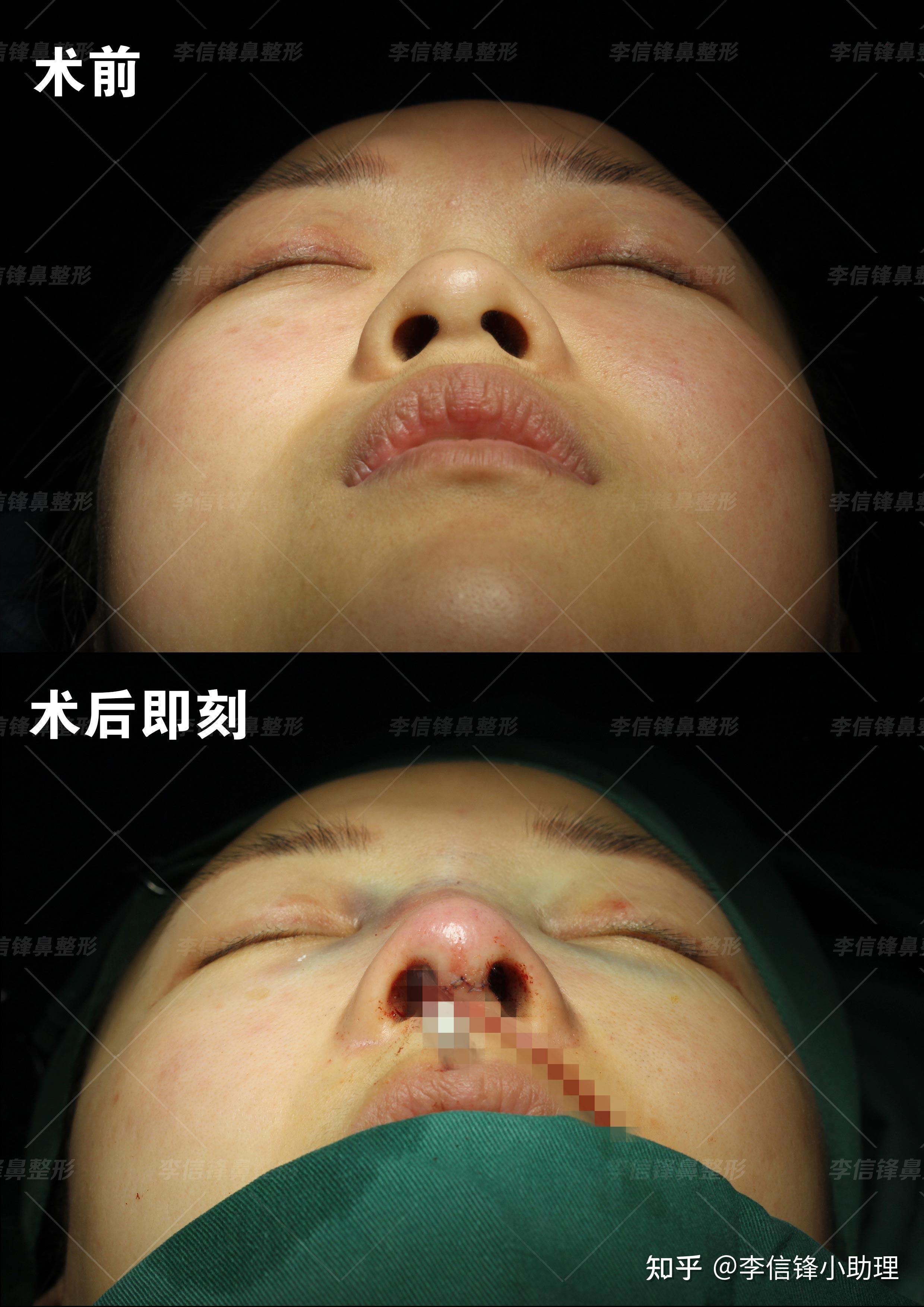 鼻子短、鼻梁塌、鼻基底凹陷?这次分享的案例中小姐姐是初鼻,鼻子存在上述三个问题,看看改变吧—深圳李信锋隆鼻综合整形 - 知乎