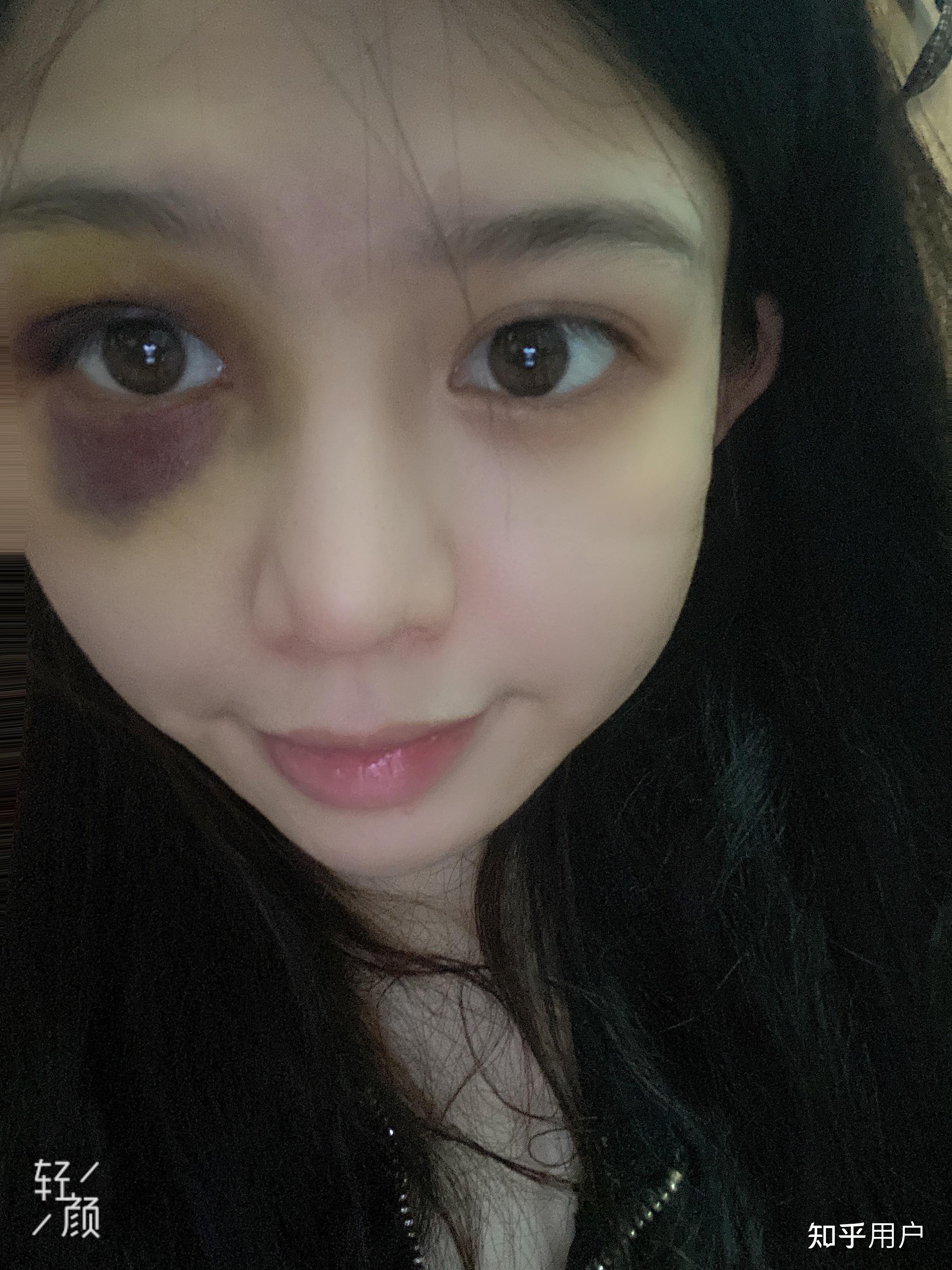 想知道眼部淤青怎么可以快速消除? - 知乎