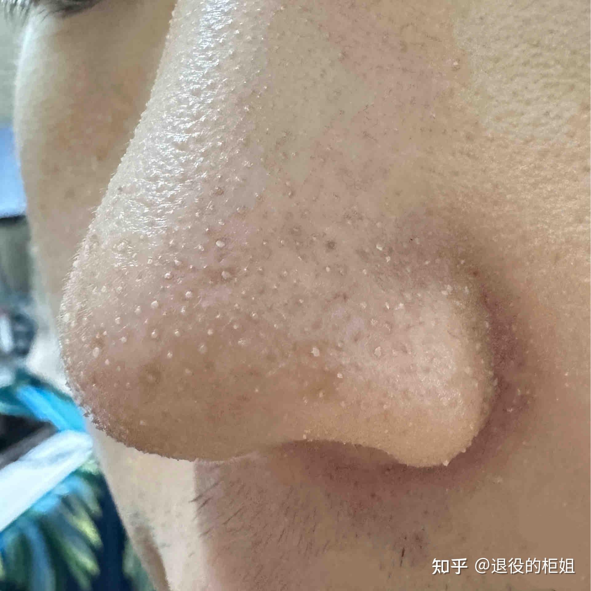 脸上有很多黑头怎么办? - 知乎