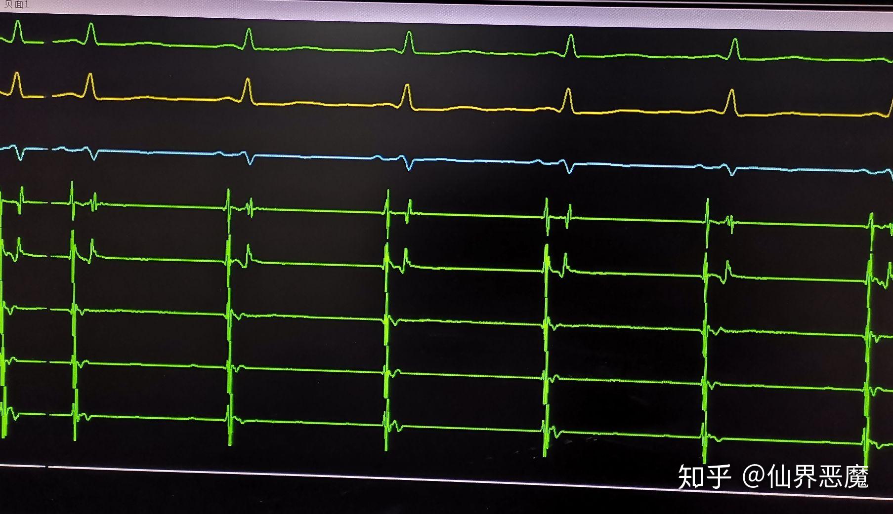 心电图窦性心律短pr间期是什么意思