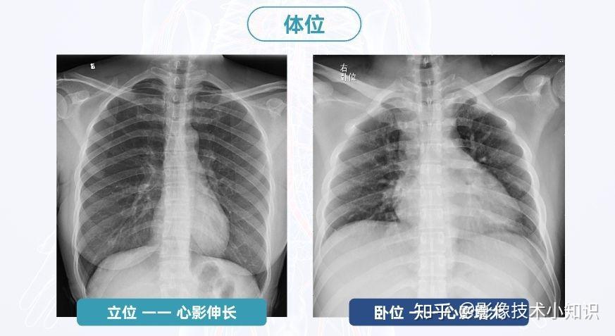 正常心脏x光图片图片