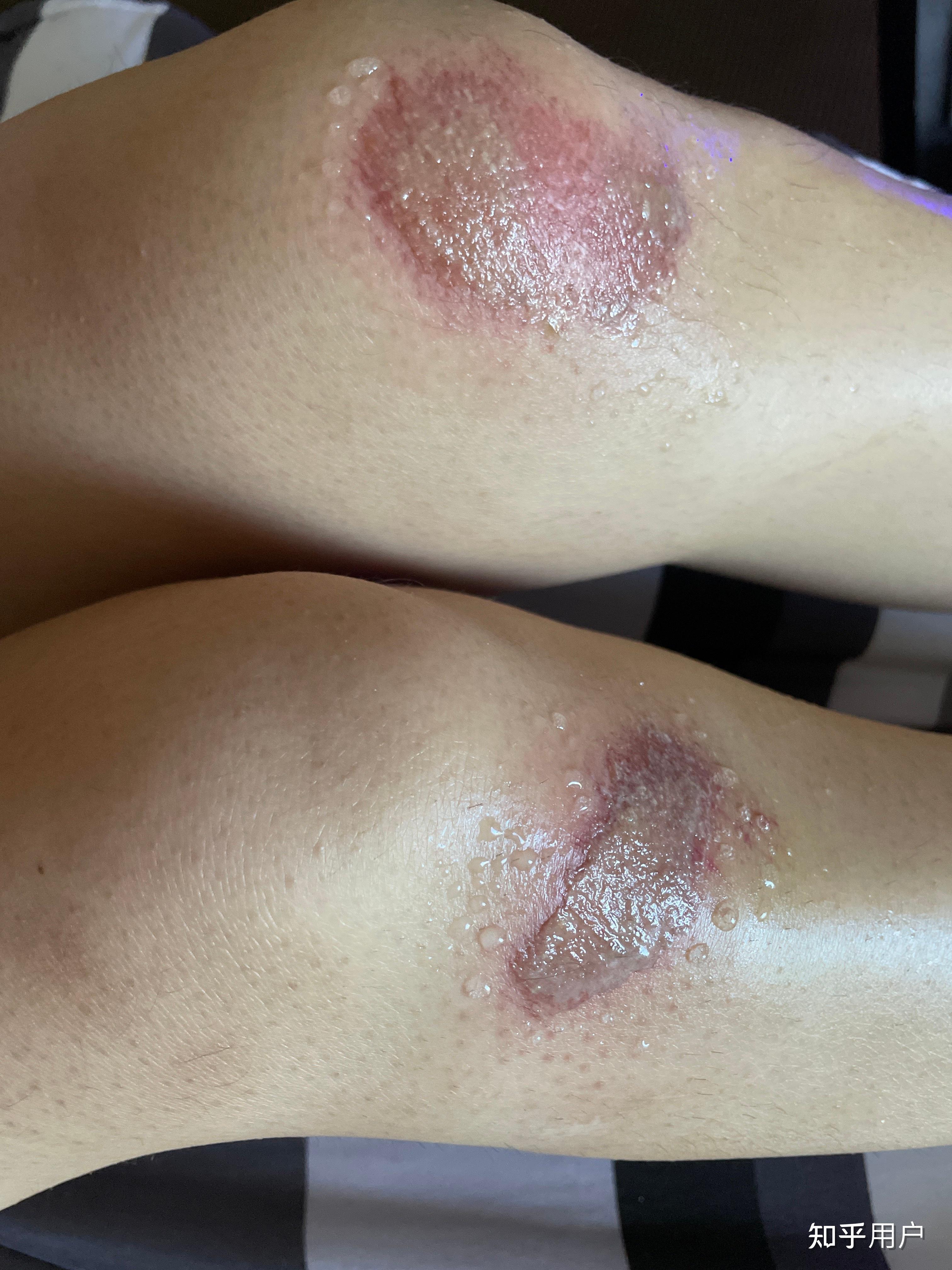 膝盖摔伤,破了一大块皮,流水,抹云南白药好了一点,三天后开始流水了